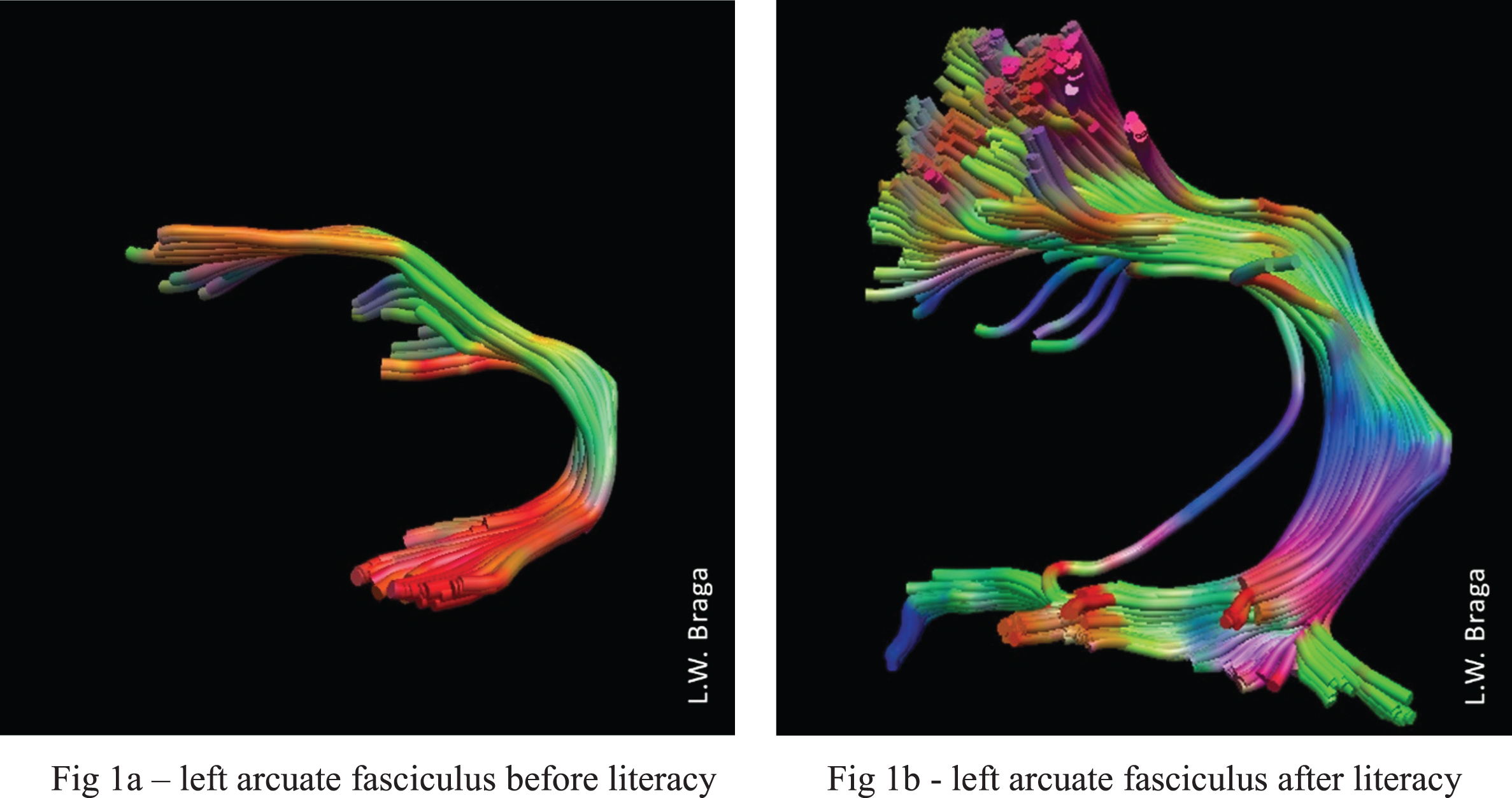DTI images of the participant’s left arcuate fasciculus (a) before and b) after intervention. There was a significant increase in number of fibers, volume, and length of the left arcuate fasciculus after literacy acquisition.