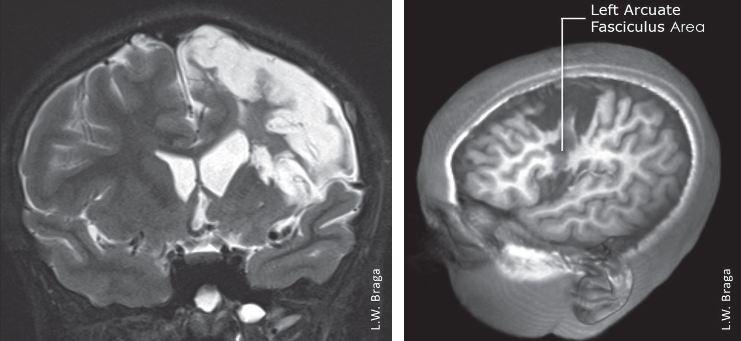 MRI images of TF ten months after injury, showing extensive lesion in the left cerebral hemisphere affecting brain areas responsible for language. There was an important lesion in the left arcuate fasciculus.