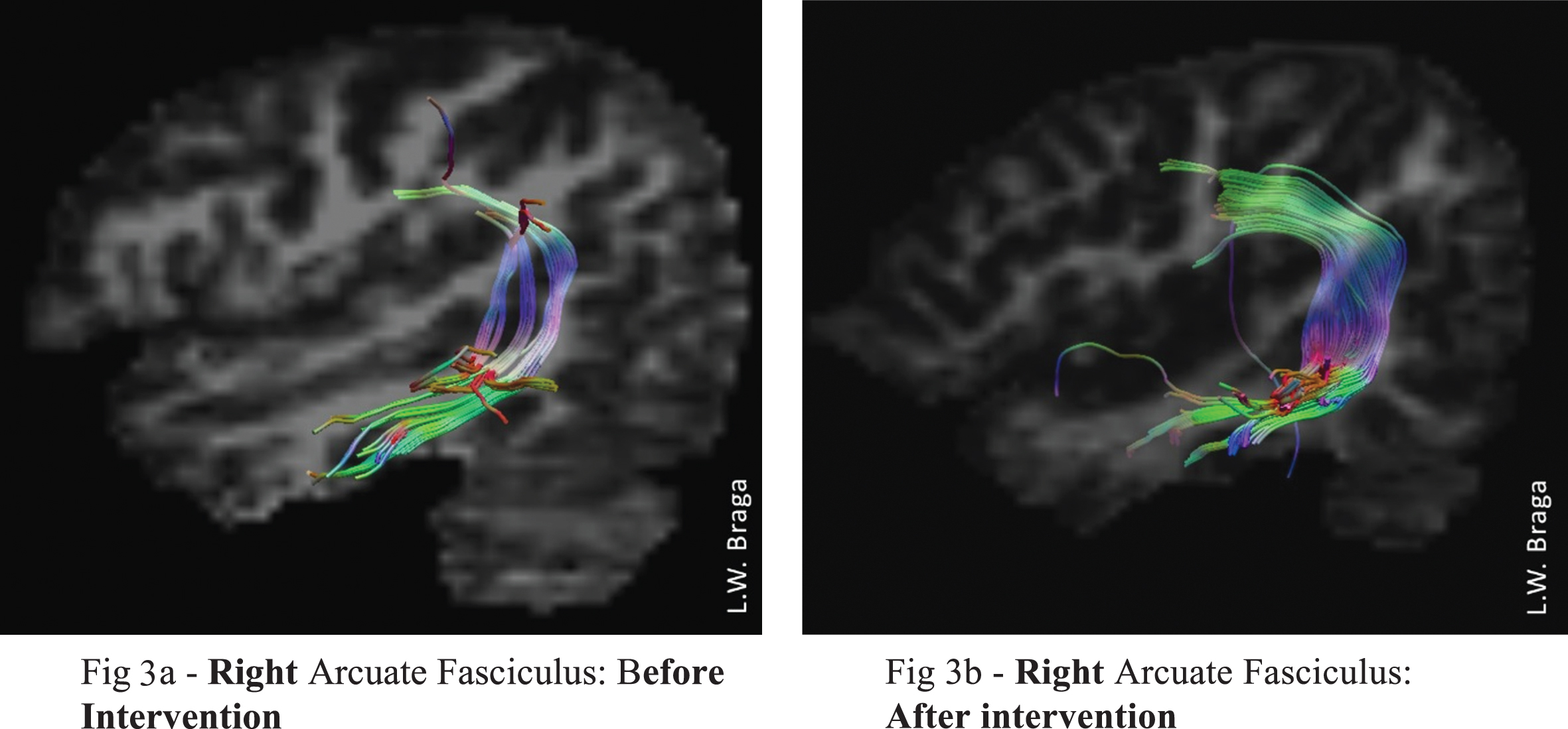 DTI images of TF’s right cerebral hemisphere (a) before intervention and b) after intervention show a neurostructural increase in white matter. There was a significant increase in number of fibers, volume, and length of the right arcuate fasciculus after intervention.