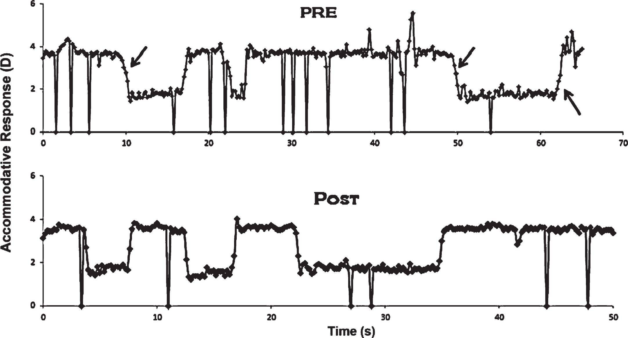 Unedited monocular step accommodative response traces as a function of time in a typical mTBI subject before (pre) and after (post) accommodative training. Large deflections represent blinks. Arrows denote slowed dynamic trajectory. D = diopter. Reprinted with permission from Thiagarajan, 2012.