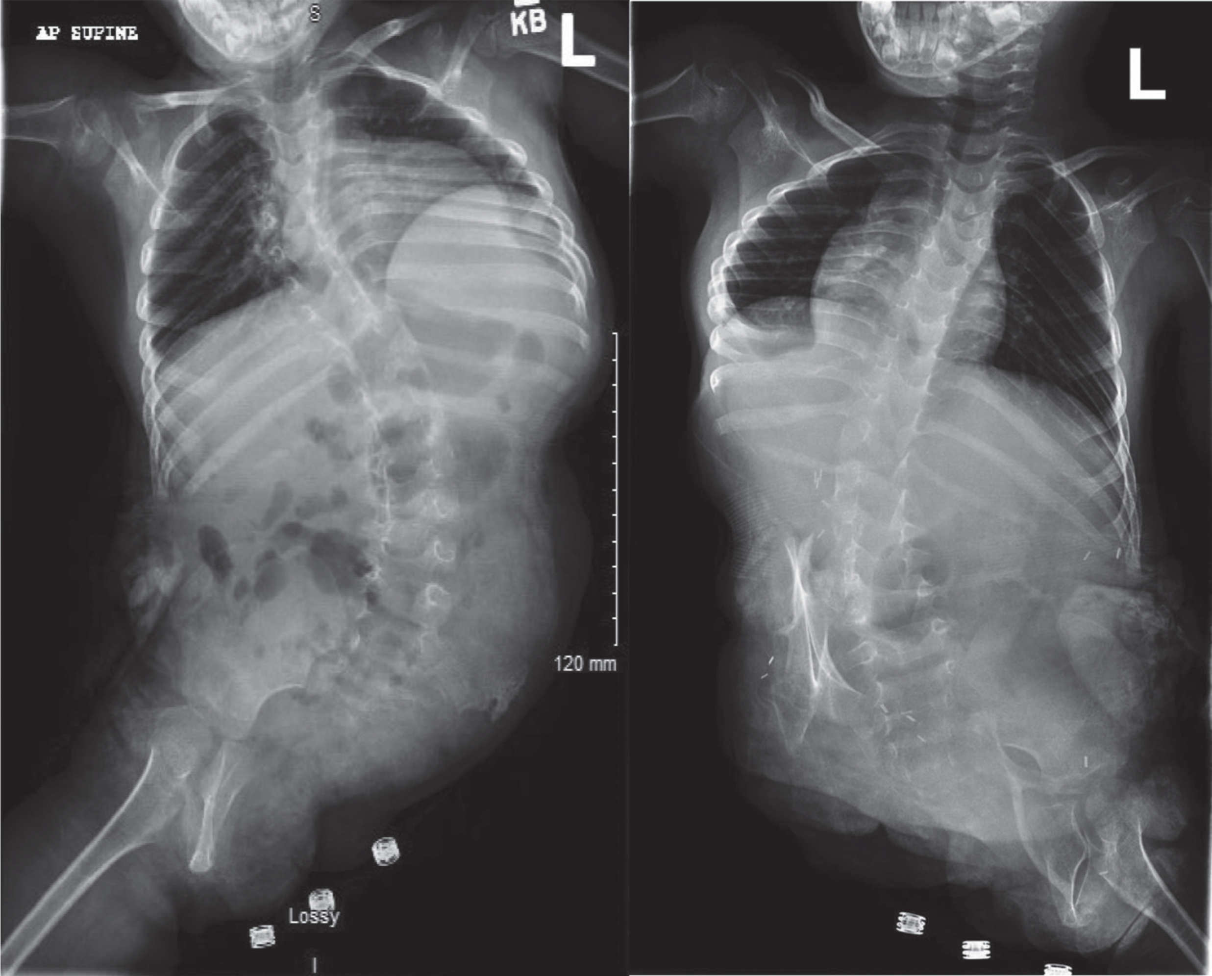 Scoliosis radiographs of the twins post-separation reveal each twin had a hemipelvis.
