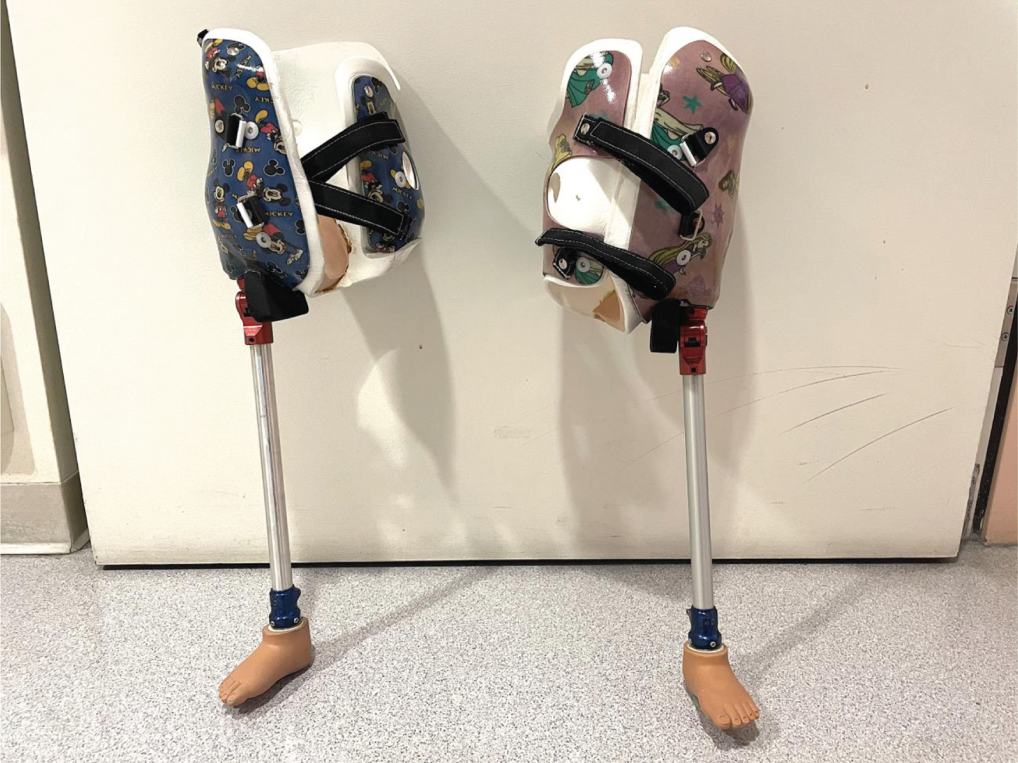 The hemipelvectomy prosthesis included a non-articulated pylon with a solid ankle cushion heel foot for a stable base of support. This was directly connected to the thoracolumbosacral orthosis.