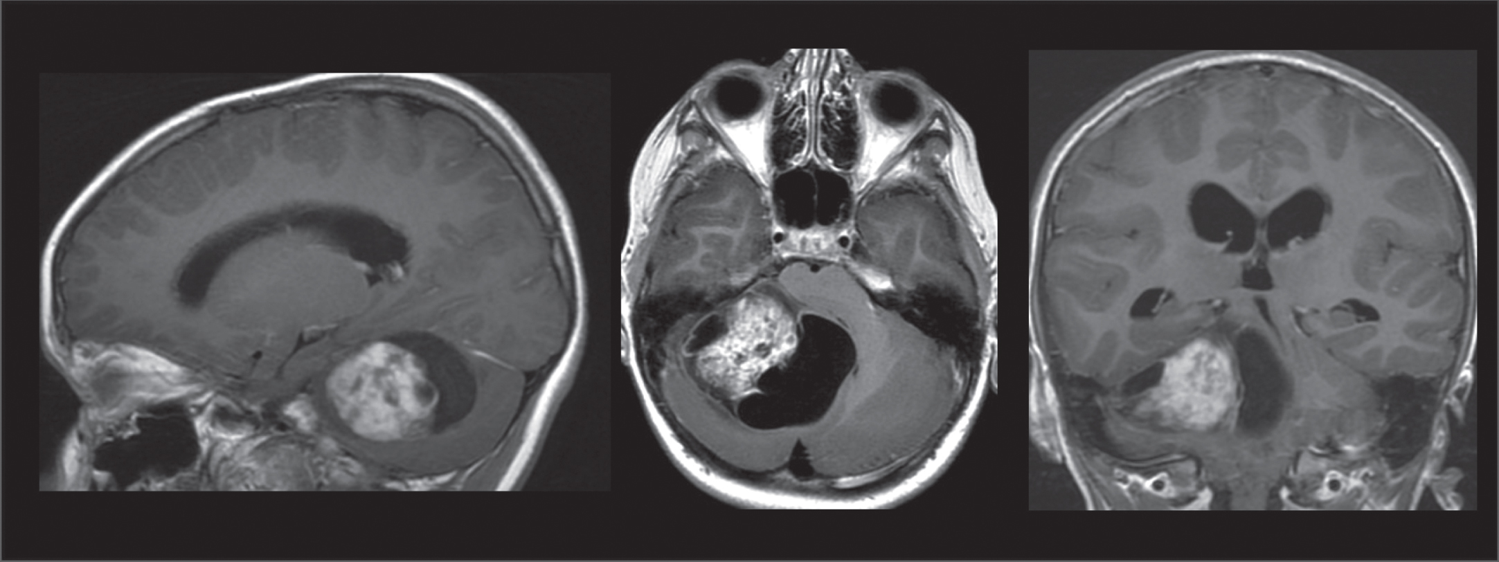 MRI findings of a tumor in the right cerebellar hemisphere. T1 weighted sequences in a sagittal, axial, and frontal view.
