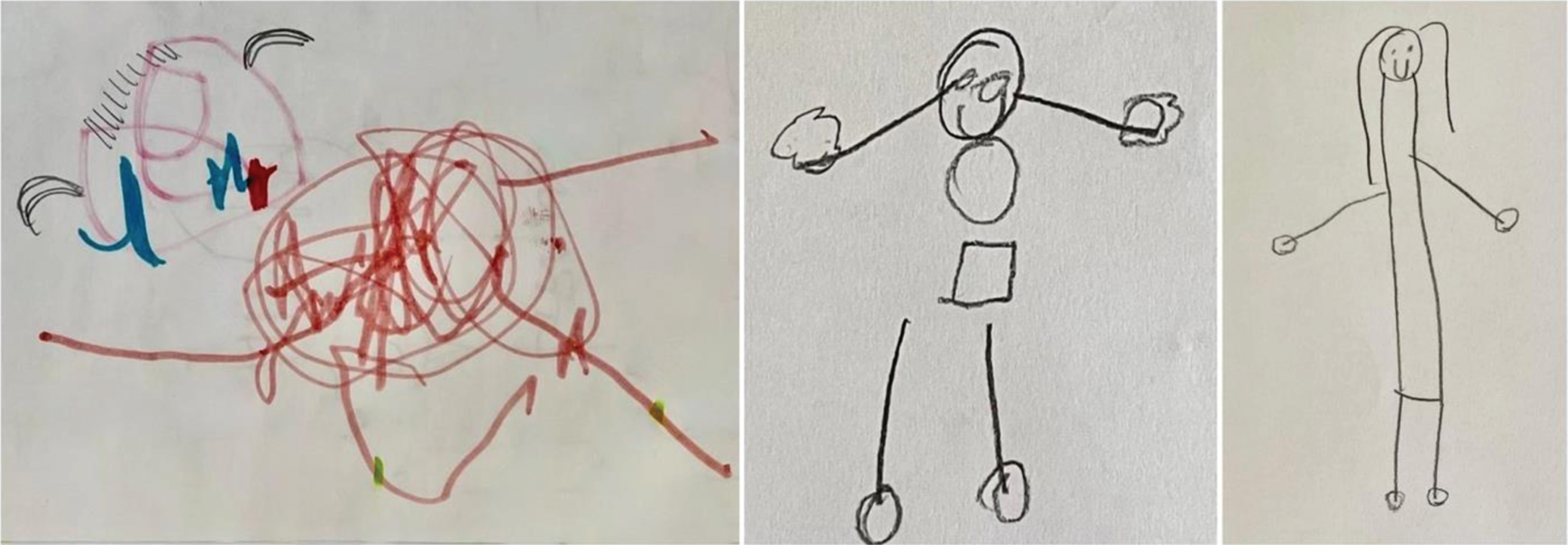 Progress in drawing the human figure. In the most recent version (age 13), some progress was noticed compared to the previous performance. Indeed, the human figure was recognized, the drawing was well-placed on the page, details such as the face with eyes, mouth, and hair were depicted, and the trunk was elongated with correctly placed legs and arms. The drawing matched a mental age of five years.