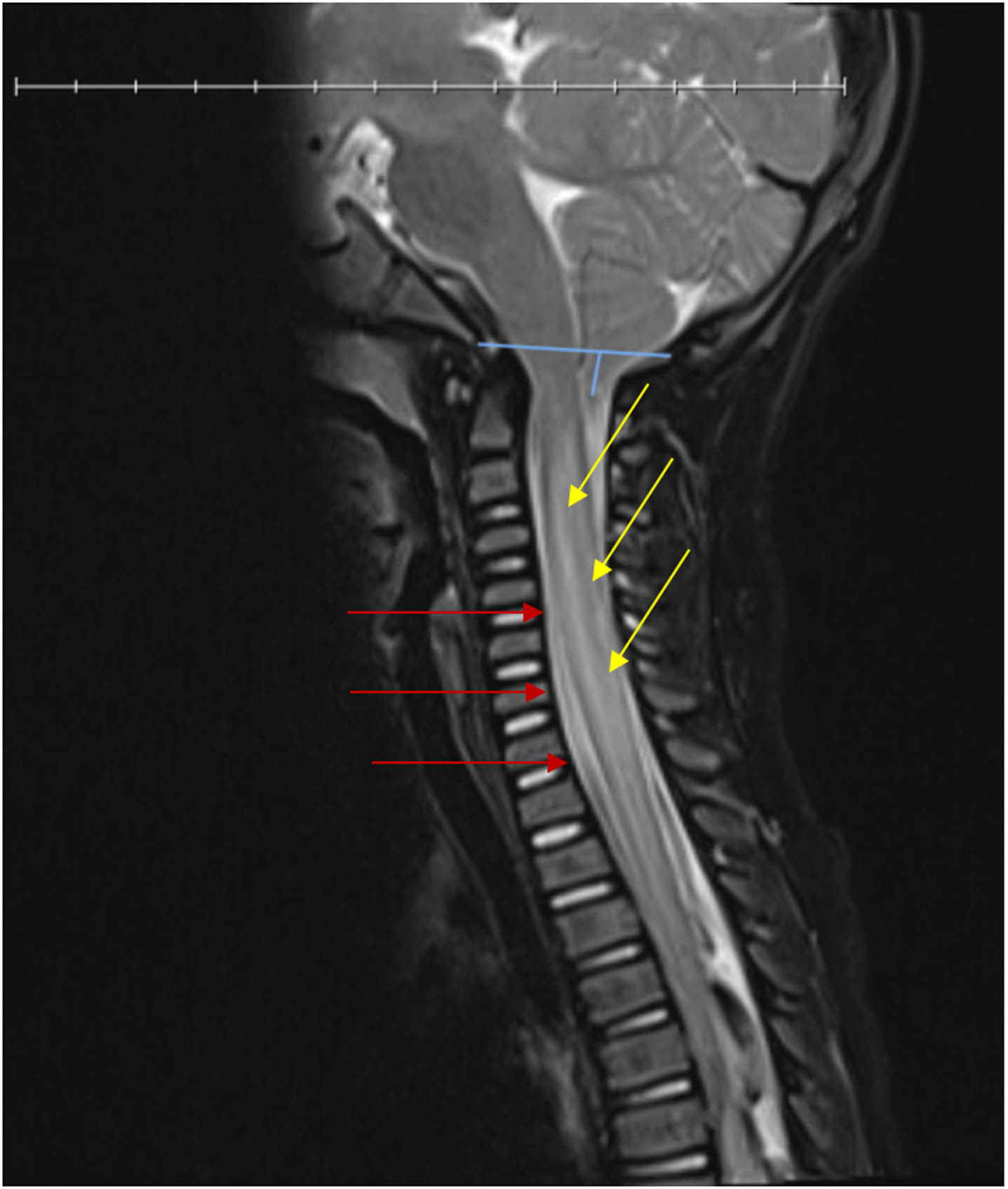 T2 weighted MRI of cervical spinal cord showing swelling with cord signal changes (right, yellow arrows) and diffusion restriction from levels C2-T3 with a ligamentous injury (left, red arrows) and Chiari I malformation (top, blue lines).