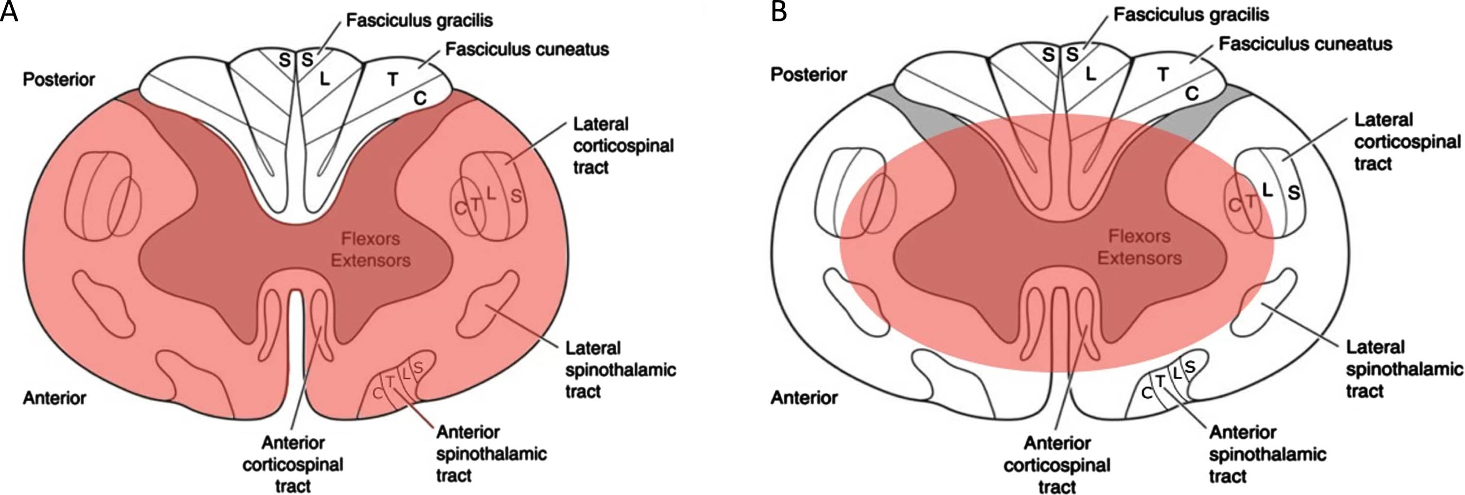 Axial drawings of spinal cord for visual demonstration of (A) simultaneous anterior and posterior spinal cord compression affects the medial aspect of the lateral corticospinal tracts in central cord syndrome and (B) loss of blood flow to the anterior spinal artery leads to involvement of the anterior 2/3 of the spinal cord, as observed in anterior spinal artery syndrome.