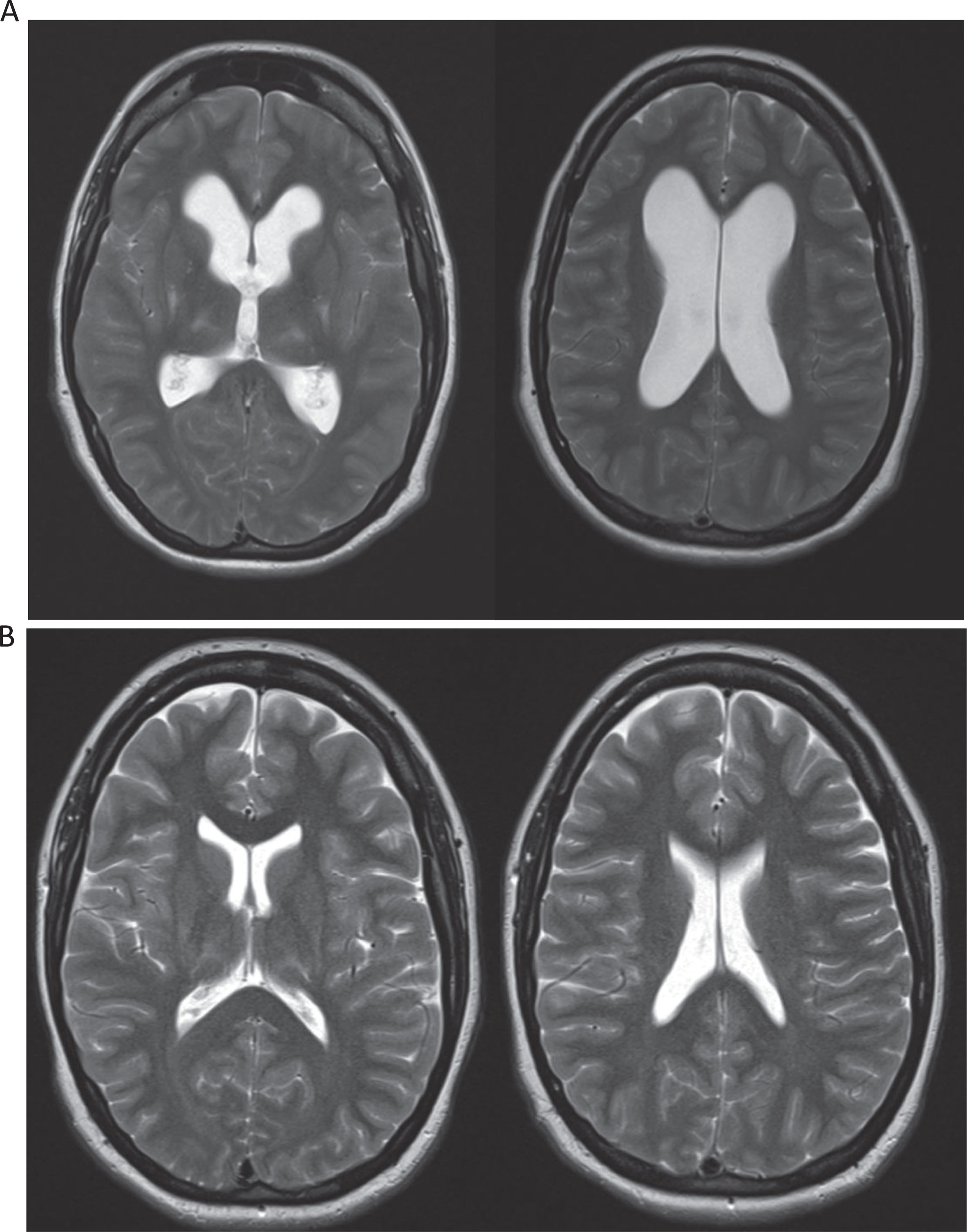 T2 magnetic resonance imaging (MRI) studies of the brain of this patient during presentation (1A) and nine years prior (1B). MRI of the brain demonstrated new diffuse moderate ventriculomegaly without transependymal edema compared to prior MRI nine years earlier (Fig. 1A and B), compatible with non-obstructive hydrocephalus.