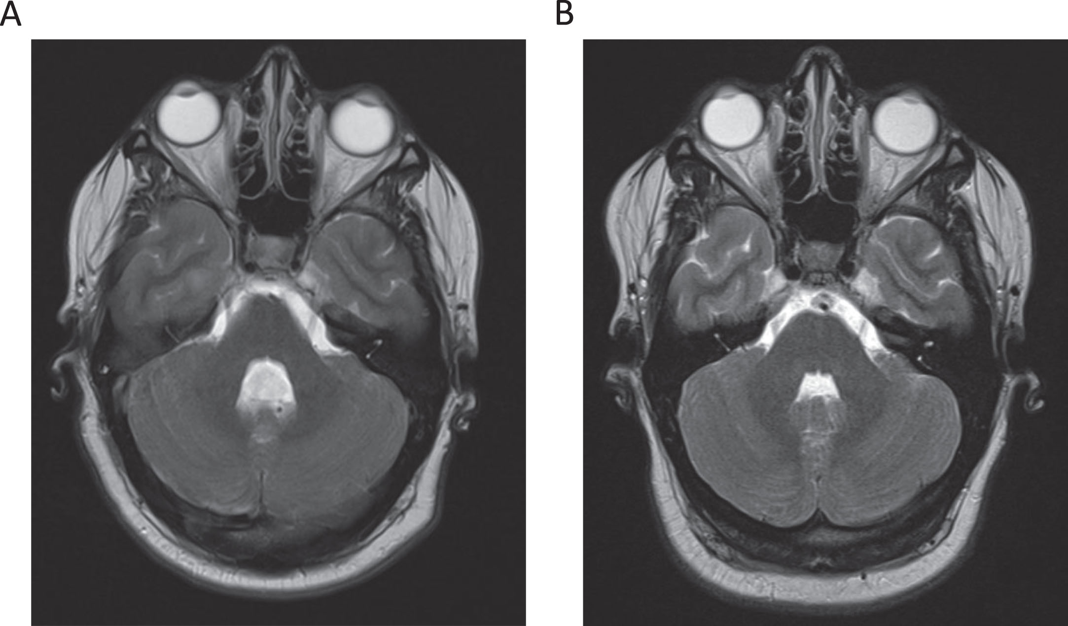 T2 magnetic resonance imaging (MRI) studies of the brain of this patient during presentation (2A) and nine years prior (2B). MRI of the brain demonstrated new fourth ventricle ventriculomegaly compared to prior MRI nine years earlier.