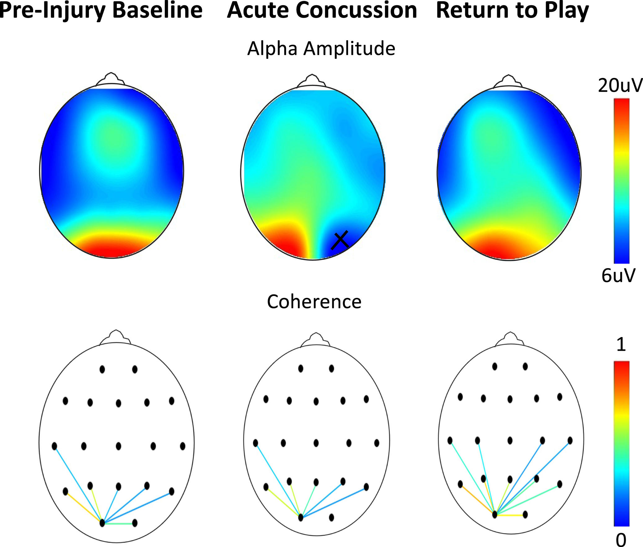 Assessments as a function of scalp location on an athlete at baseline, 48 hours after a concussion, and after symptom resolution one month later. (Top) Alpha amplitude (x = bad channel). (Bottom) Occipital connectivity (from O1 electrode, display threshold = 0.2). As per Table 2, no differences are seen in either the frequency or coherence.