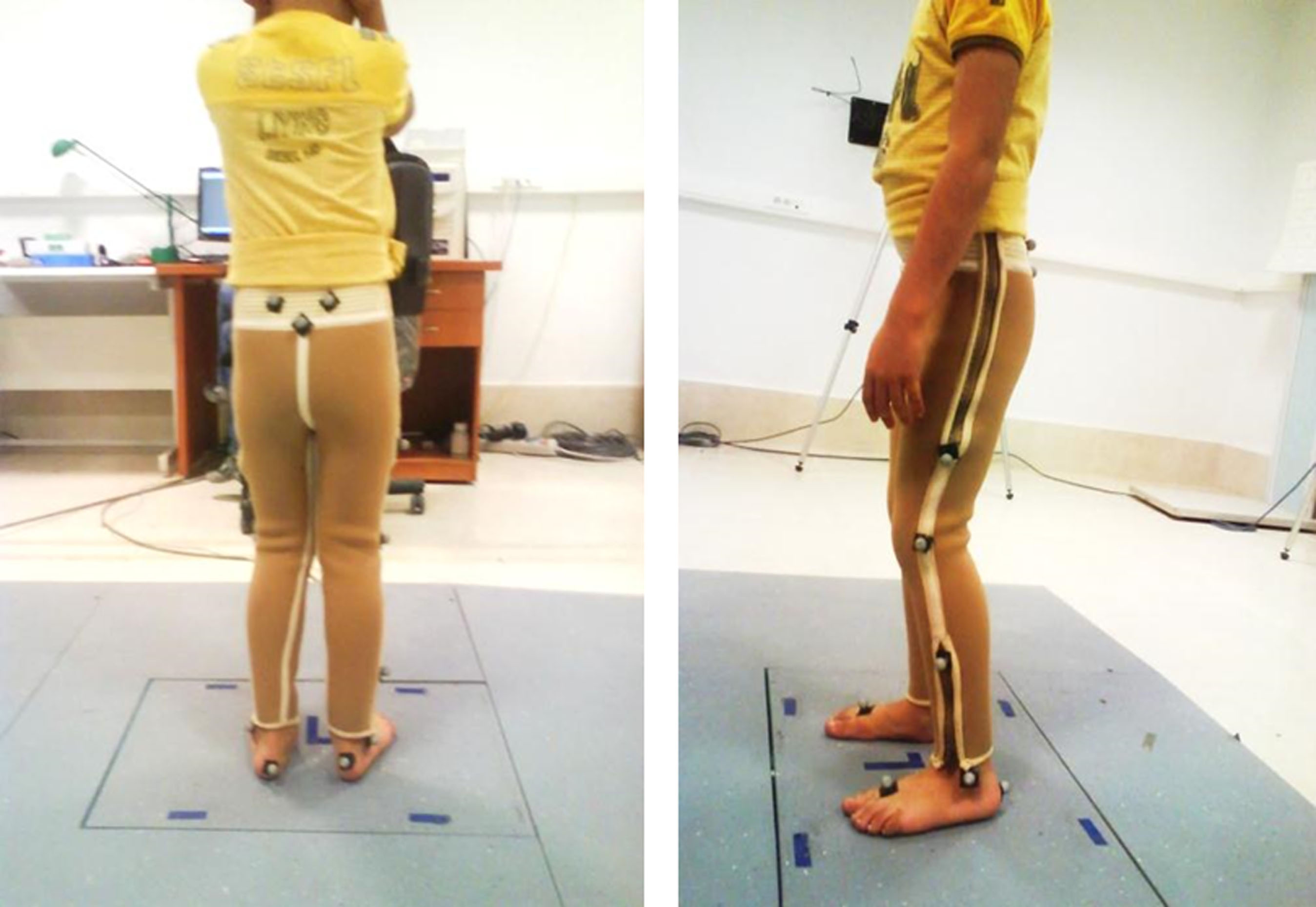 Posterior and lateral views of the dynamic neoprene orthosis used in this study showing the position and mounting arrangement of the markers. (Two markers of 17 markers on iliac crests are not visible in these photos.) The parents’ consent has been received to use these photographs.