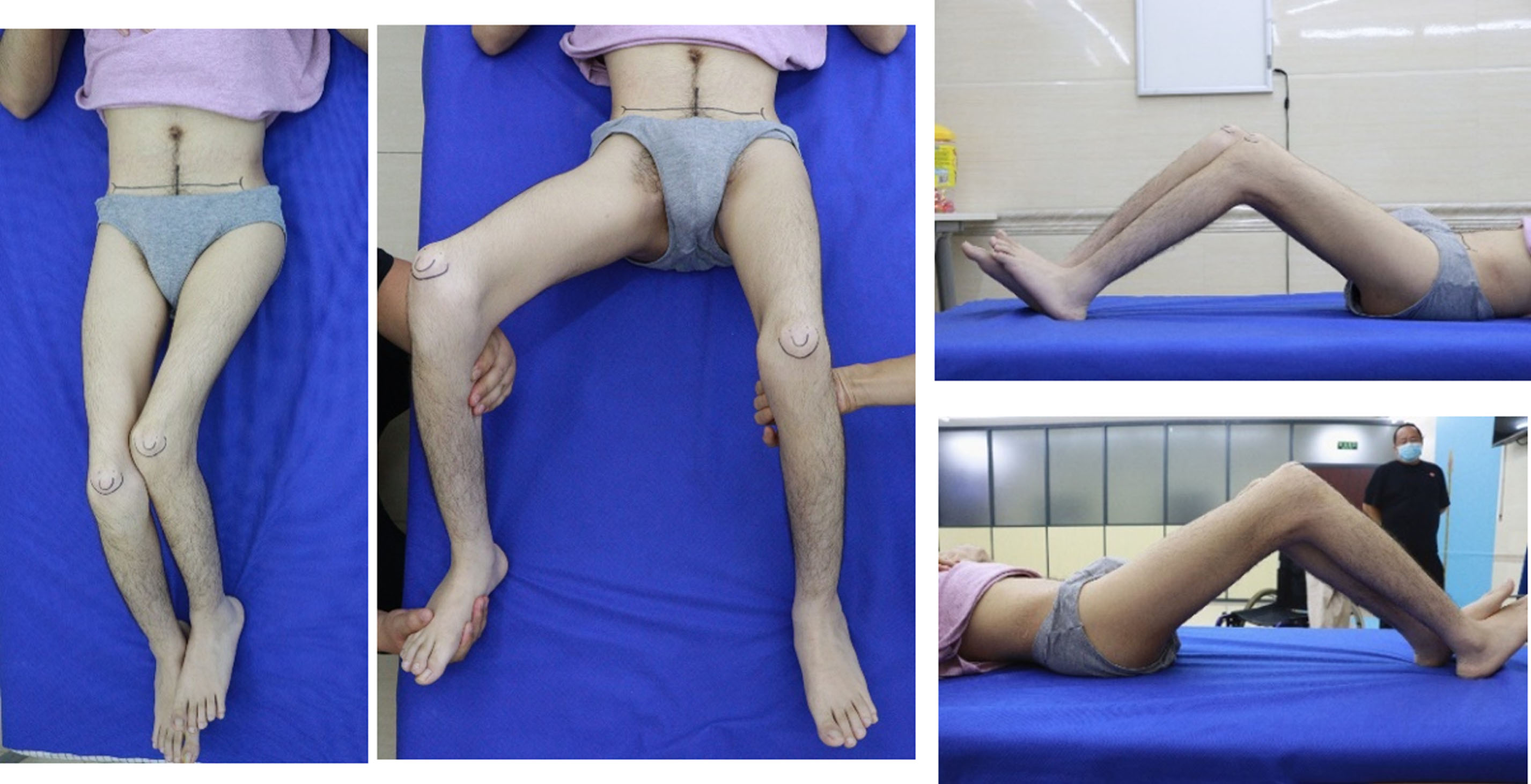 A physical exam revealed a fixed adduction shortening of the left thigh segment, bilateral knee flexion contractures, bilateral hip flexion contractures, and patella alta.