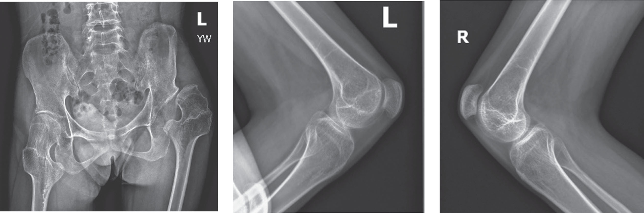 Preoperative x-rays reveal dislocation of the left hip, bilateral knee flexion contractures, and patella alta.