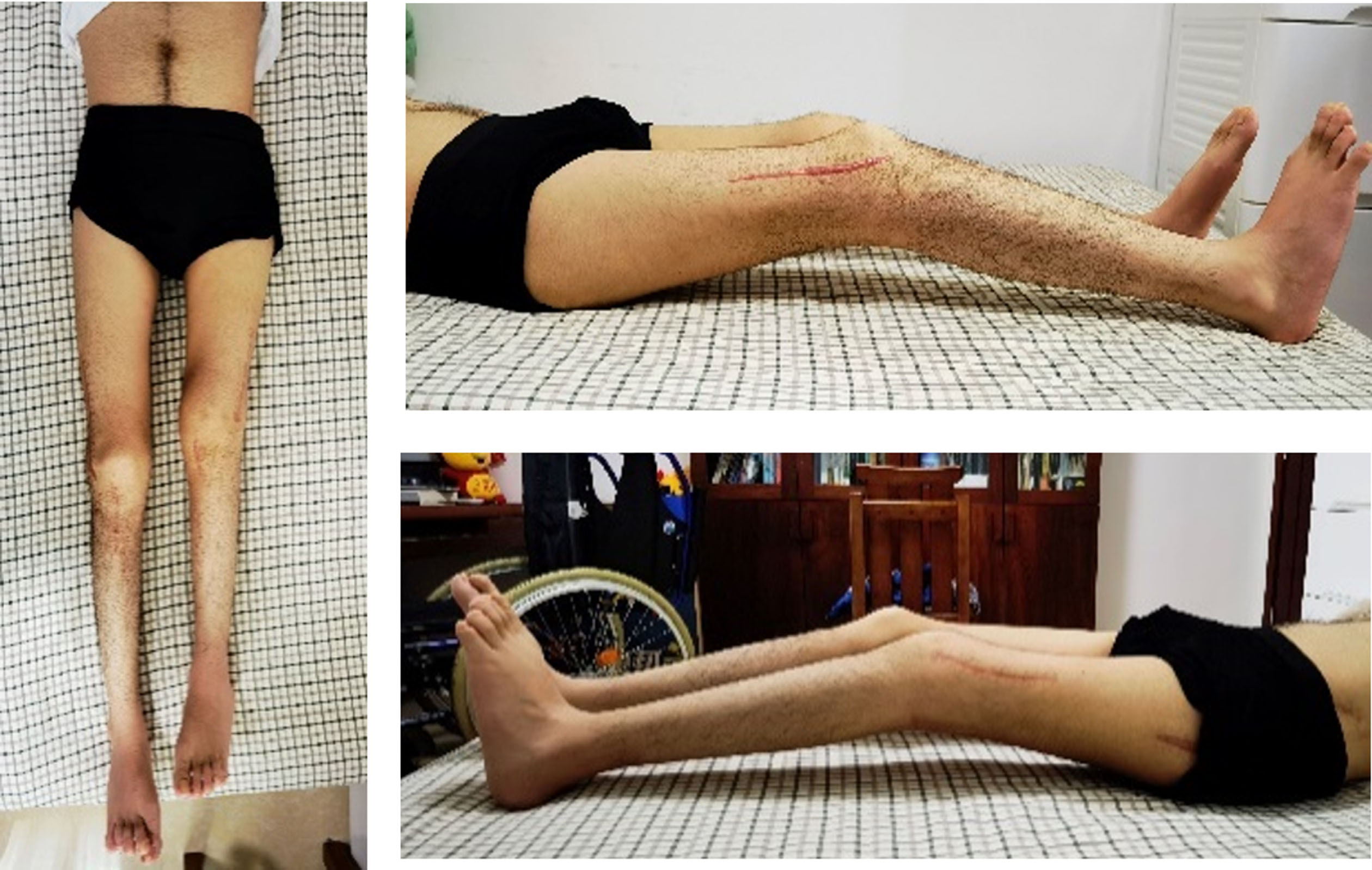 Postoperative alignment with improvement of hip extension, knee extension, and patella alta.