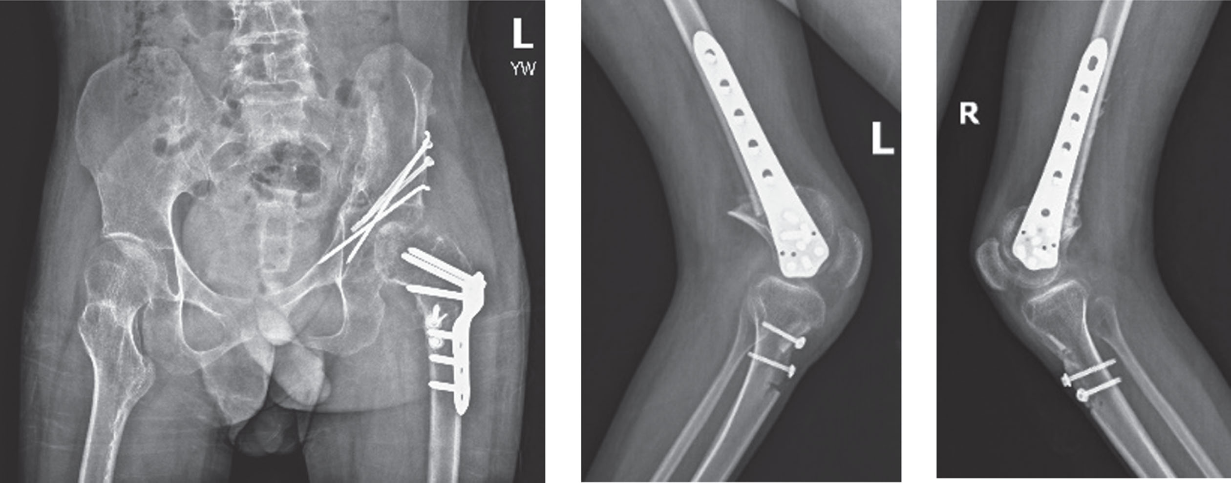 Postoperative x-rays after proximal femoral extension, varus, and rotation osteotomy, distal femur extension osteotomy, and patellar advancement.