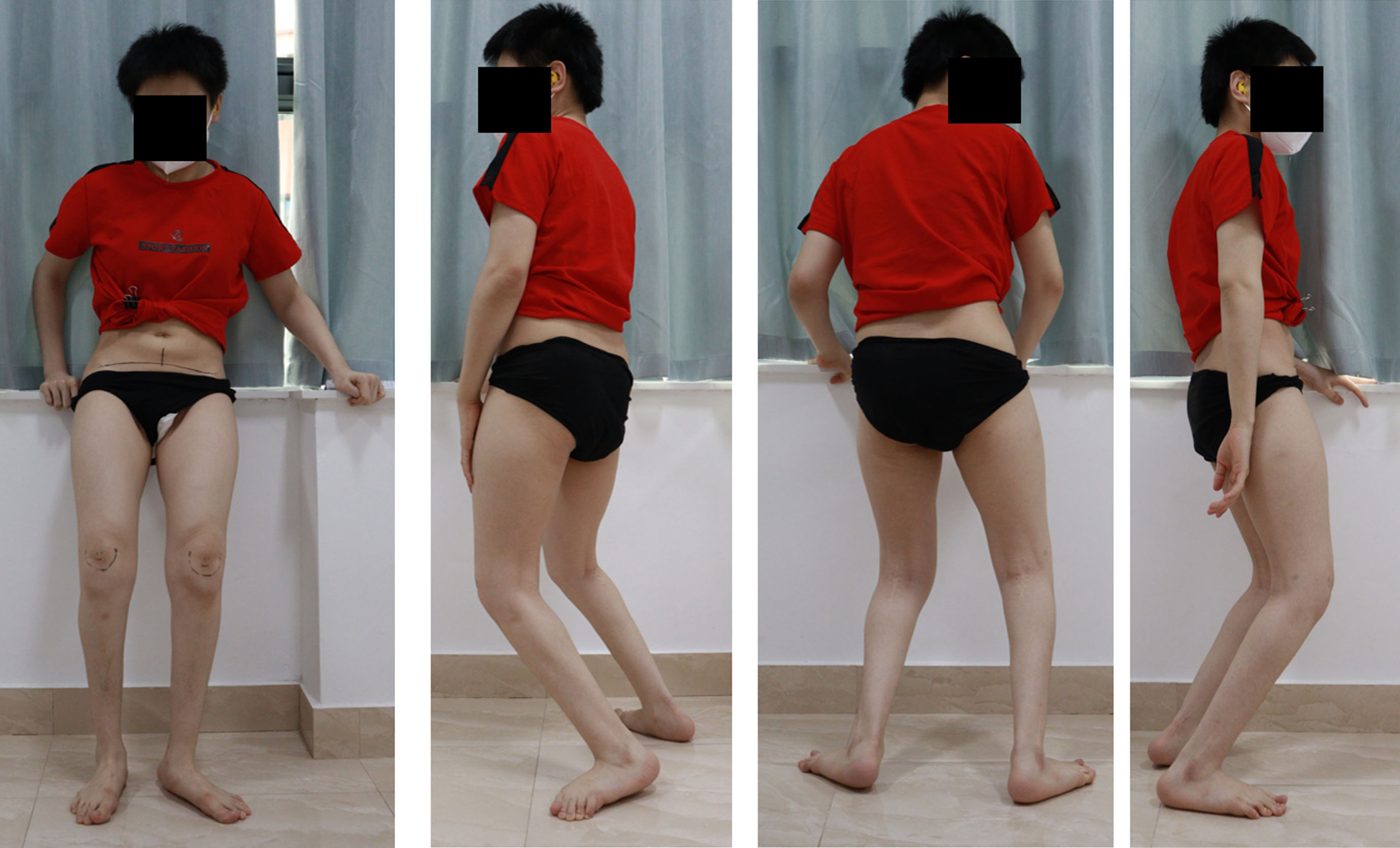Standing posture reveals flexed hip, flexed knee, and ankle dorsiflexion with anterior pelvic rotation.