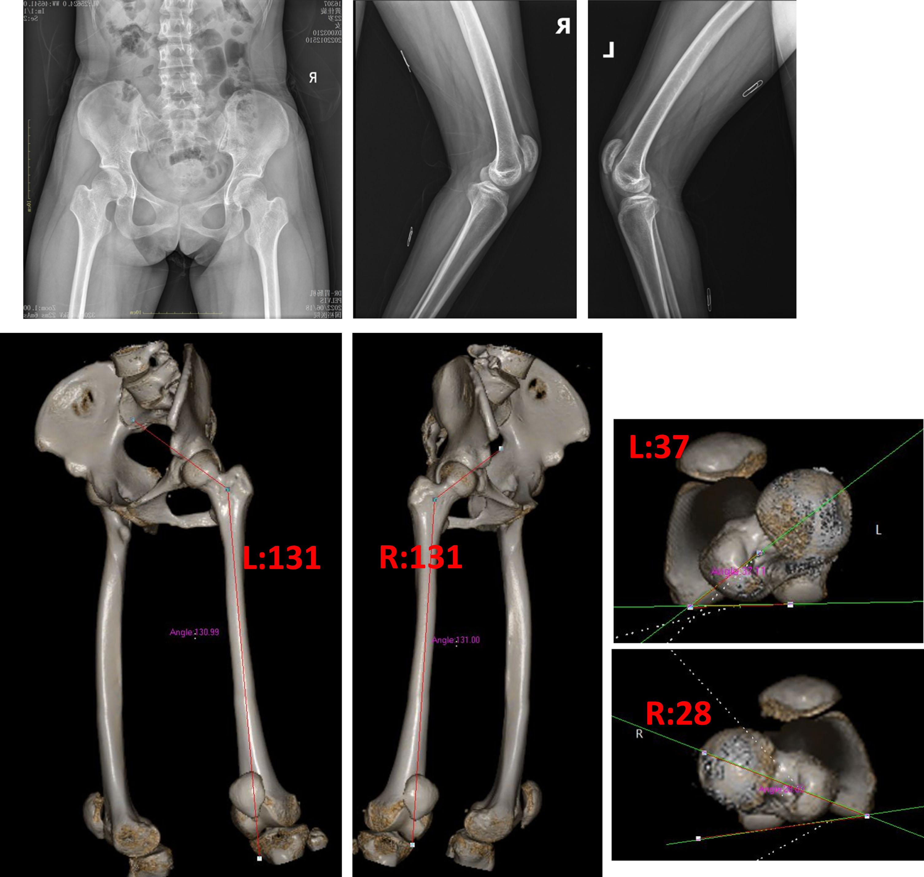 Preoperative imaging revealed good coverage of the hips, knee flexion, and patella alta. On the CT anteversion, the left was 37 degrees and the right 28 degrees. The neck shaft angle was 131 degrees bilaterally.