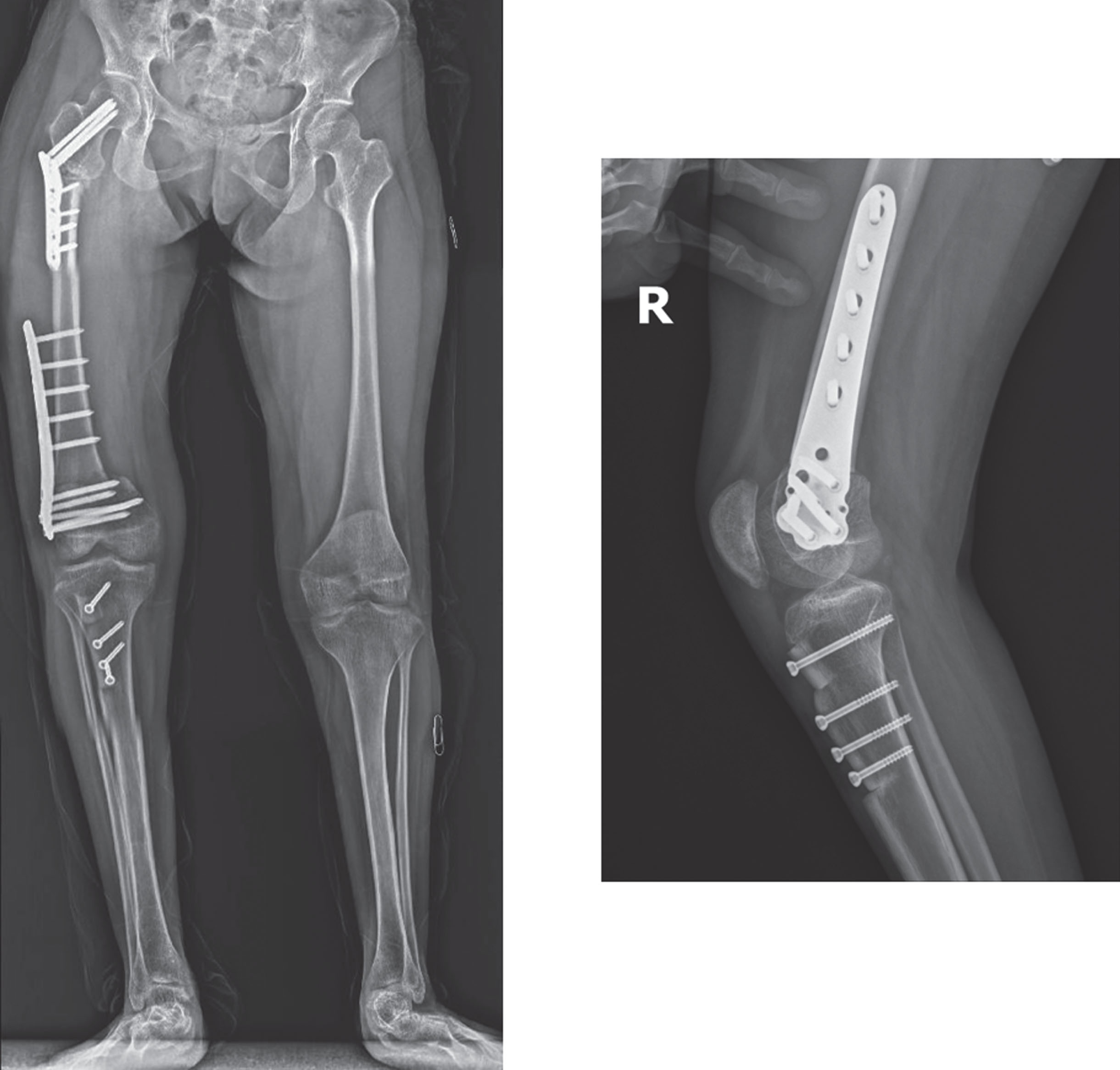 Right side reconstruction with proximal femur extension rotation osteotomy, distal femur extension osteotomy, and patellar advancement.