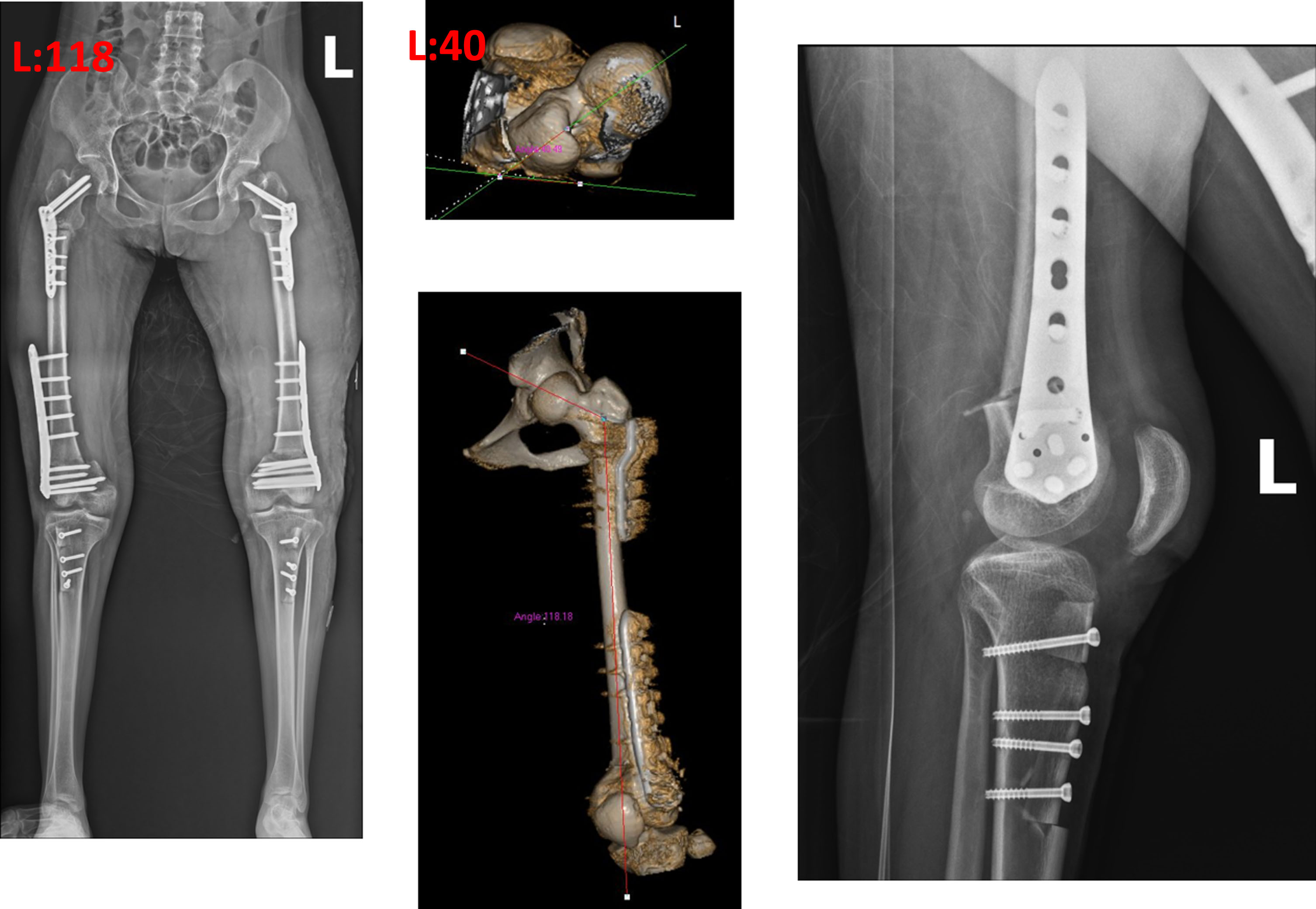 The left side was performed three months after the right with varus, extension, rotation osteotomy of the proximal femur, extension osteotomy of the distal femur, and advancement of the patella. The neck shaft angles of 131 were reduced to about 120 degrees. The anteversion was slightly increased to account for the external rotation of the limb.