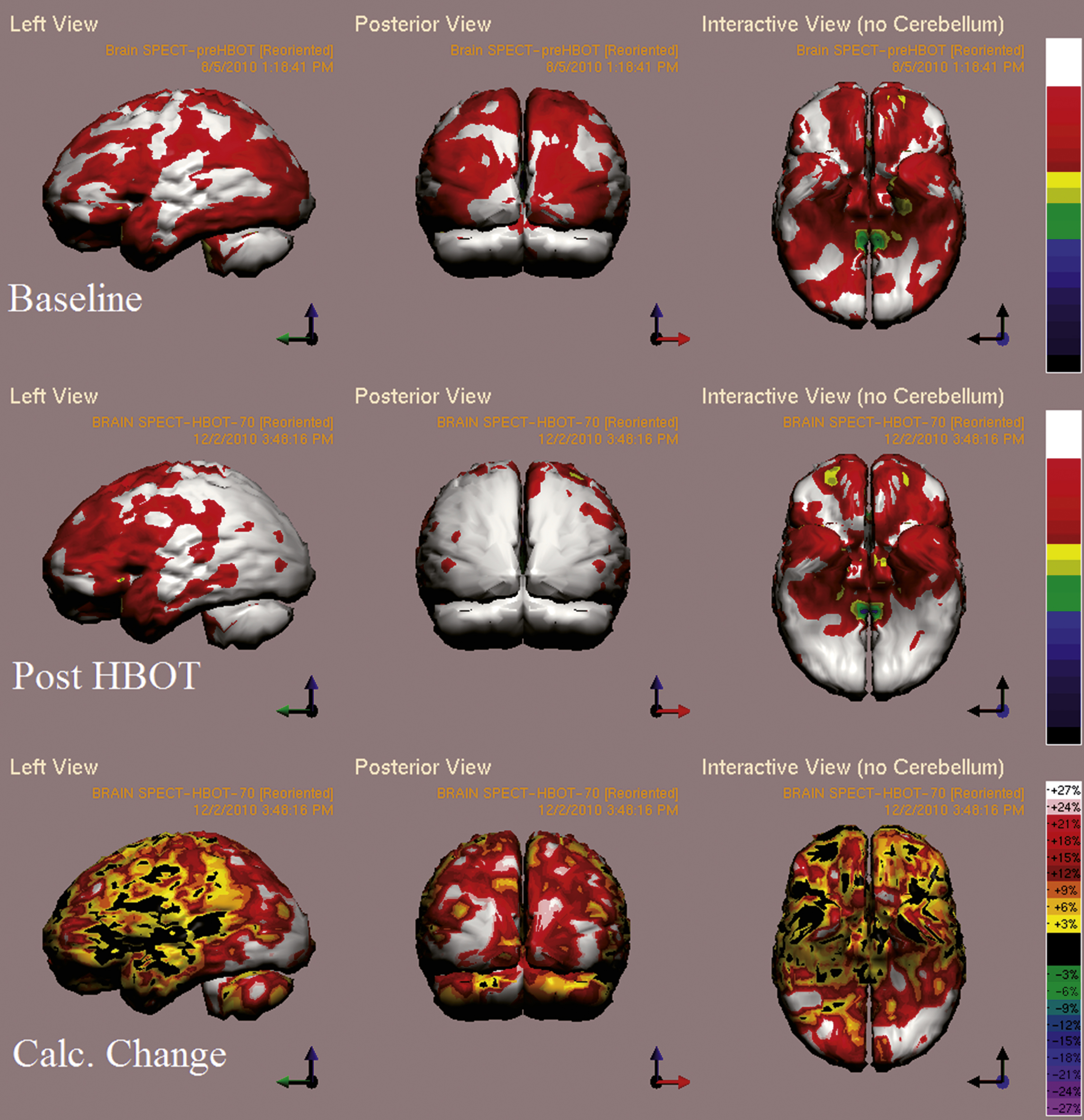 Case 1 SPECT calculated change after HBO2 compared
to baseline. In the first two rows colors represent maximal functional brain activity relative to brain median activity, where in the bottom row colors represent the regional change in functional brain activity. White and red areas show the highest changes in CBF.