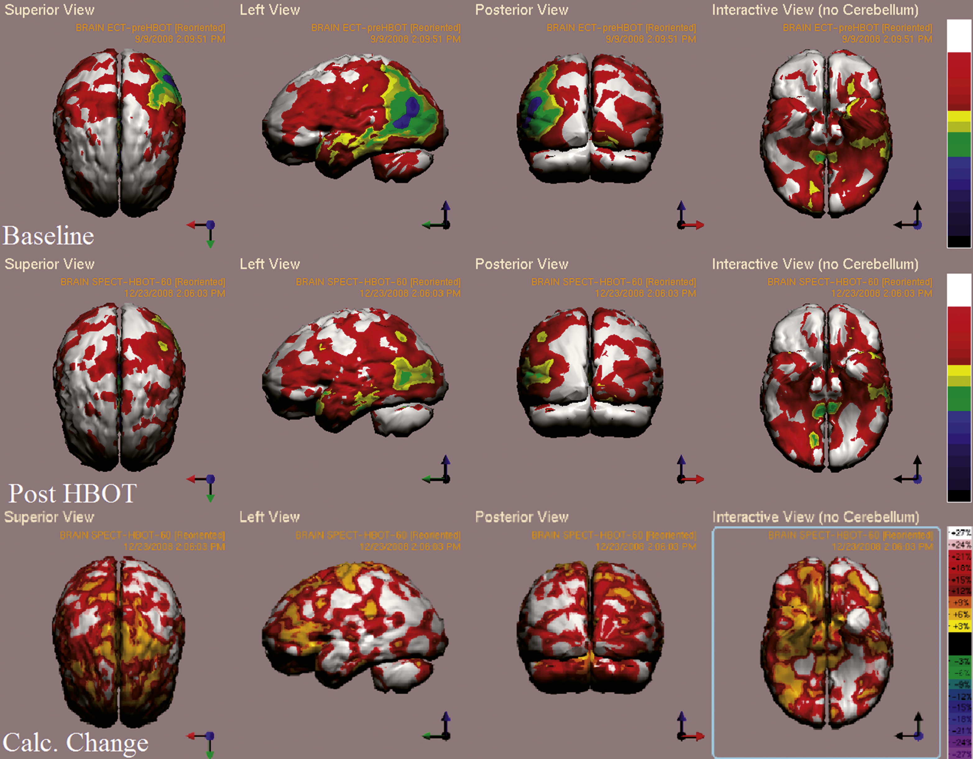Case 2 SPECT calculated change after HBO2 compared to baseline. In the first two rows colors represent maximal functional brain activity relative to brain median activity, where in the bottom row colors represent the regional change in functional brain activity. White and red areas show the highest changes in CBF.
