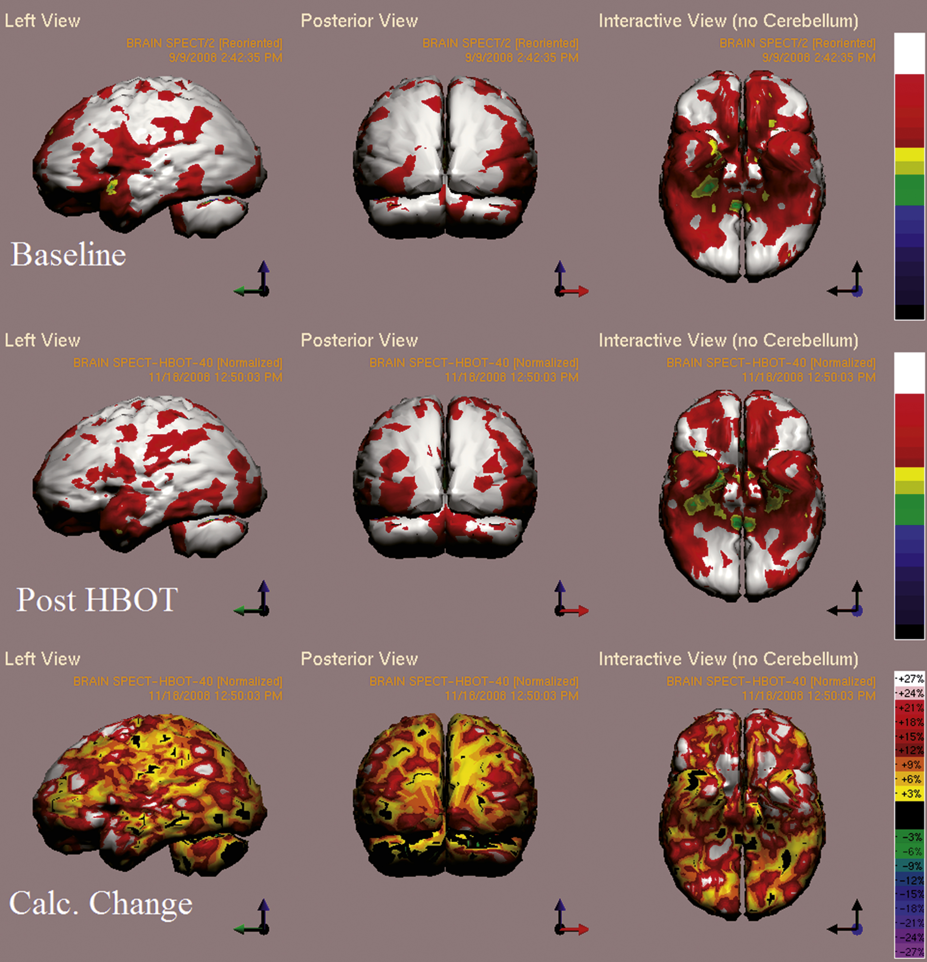 Case 4 SPECT calculated change after HBO2 compared to baseline. In the first two rows color represent maximal functional activity relative to brain median activity, where in bottom row colors represent the change in regional brain activity. White and red areas show the highest changes in CBF. Executive function, verbal, visual spatial and memory indices improved from scores of 98, 88, 84, 69 to 111, 104, 104, 79 respectively.