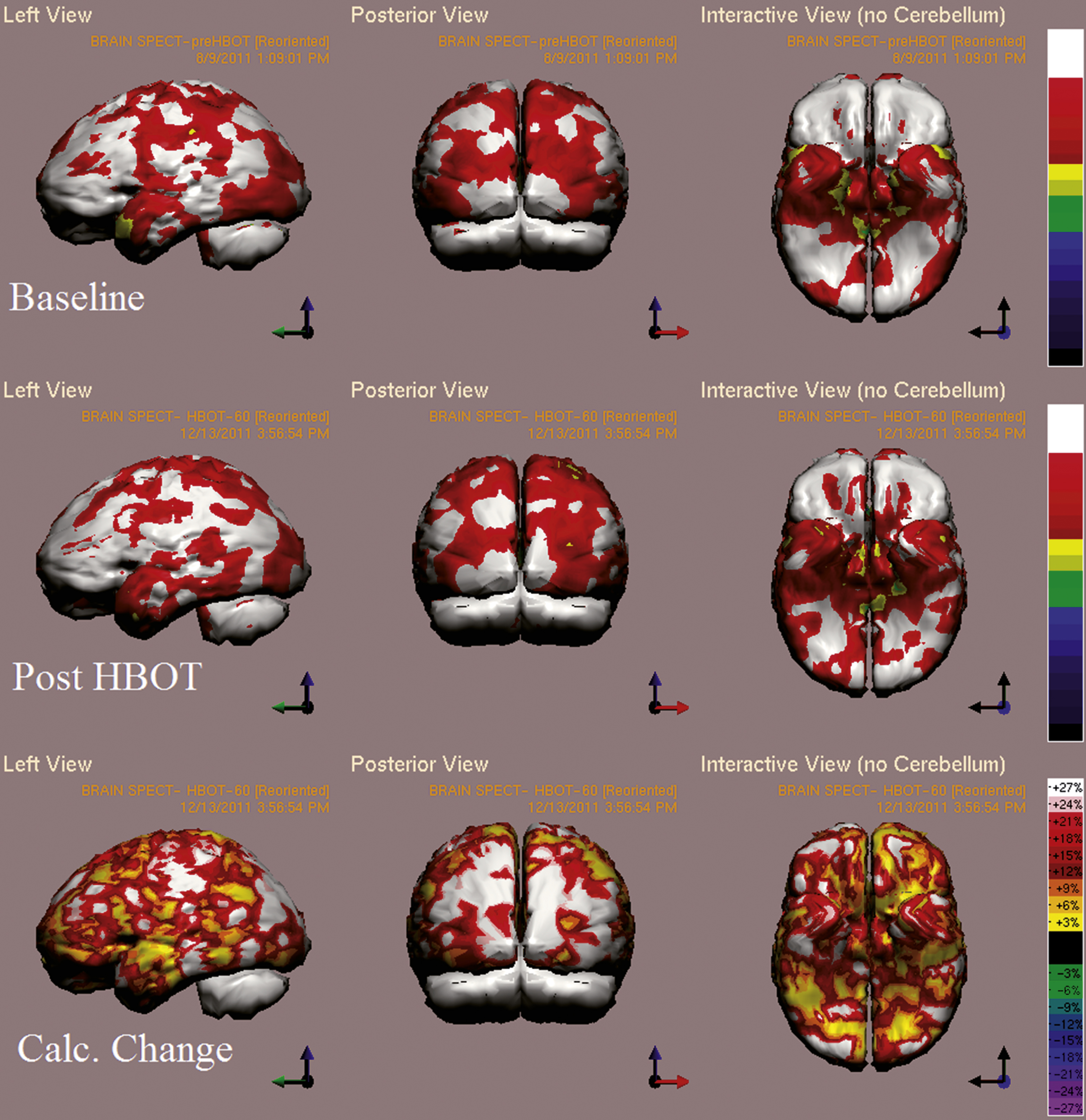 Case 5 SPECT calculated change after HBO2 compared to baseline. In the first two rows color represent maximal brain activity relative to brain median activity, where in the bottom row colors represent the change in regional brain function i.e. the change in metabolic activity. A global improvement of brain activity is demonstrated more accentuated in both occipital cortices. White and red areas show the highest changes in CBF. Executive function and attention indices improved from 44 and 38 to 62 and 59, respectively.