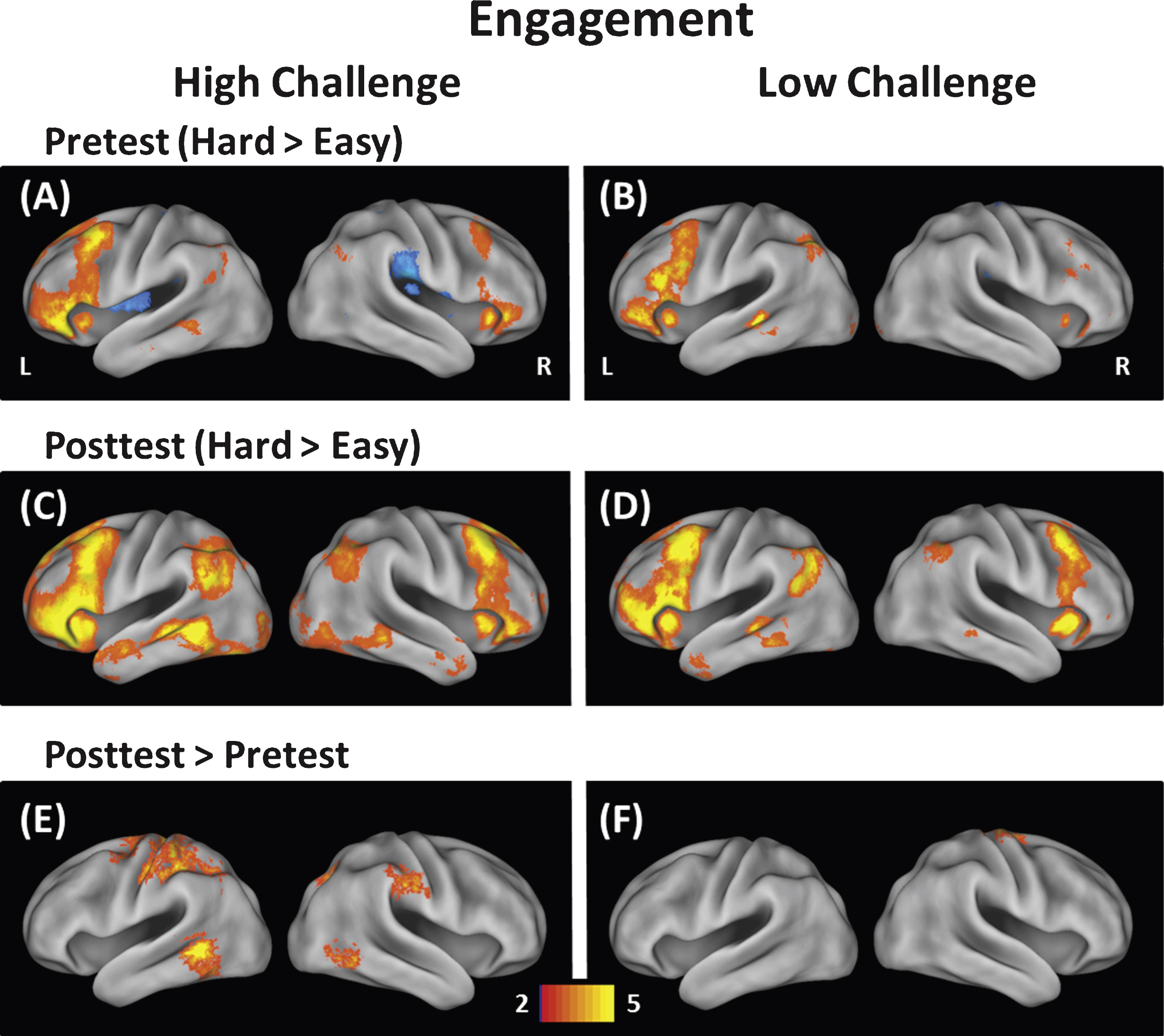 Modulation of brain activity was measured at easy and hard levels of difficulty for the High-Challenge group (left) and Low-Challenge group (right). The top panels (A & B) show modulation at pretest, the middle panels (C & D) show modulation at posttest, and the bottom panels (E & F) show modulation differences between pretest and posttest. The High-Challenge group exhibited increases in modulation of brain activity following the intervention in frontal, temporal, and parietal brain regions. In contrast, the Low-Challenge group only showed increases in modulation in one cluster (precentral gyrus).