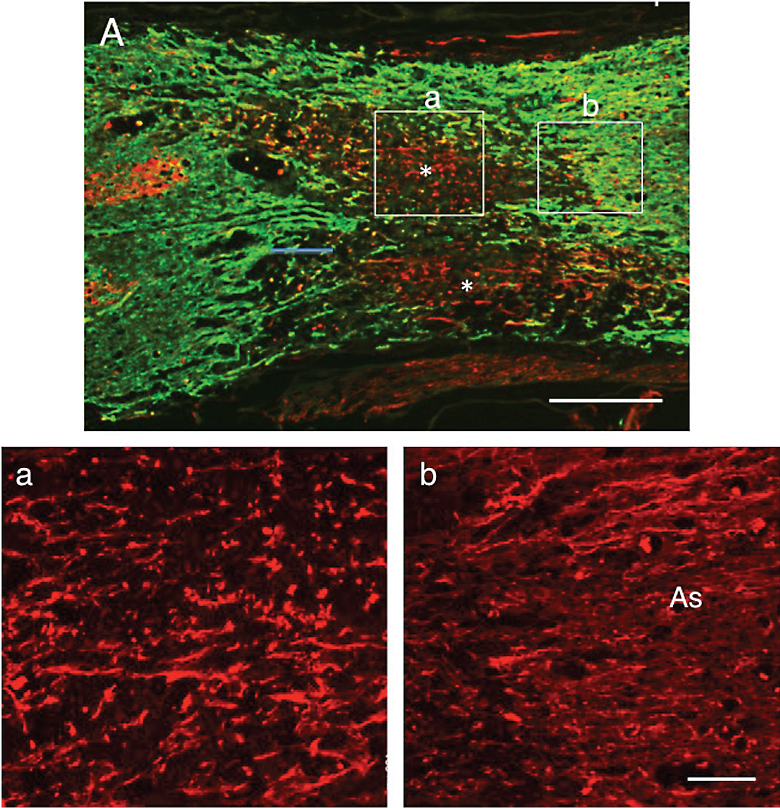 Double staining for axons (red) and astrocytes (green). 5 w-TP. A: There are astrocyte-devoid areas (*) at the lesion. There is no astrocyte scar at the border of the lesion. a: The part enclosed with rectangle a in panel A was enlarged (staining for axons). There are numerous axons with various diameters and irregular orientations in this astrocyte-devoid area. b: The part surrounded with rectangle b in panel A is enlarged (staining for axons). The region (As) corresponds to the astrocyte region (green) in rectangle b. Axons spared in the white matter at the border of the lesion are fine and longitudinally oriented. Scale: 500 μm for A, and 100 μm for a and b.