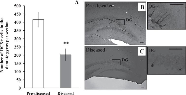 DCX+ cells in the dentate gyrus of the pre-diseased mice and the diseased mice (A) Quantification of DCX+ cells in the dentate gyrus of the pre-diseased mice and the diseased mice. Results were expressed as mean ± SEM., n = 5 for the pre-diseased mice and n = 4 for the diseased mice. Data was analysed by Student’s t-test. **p < 0.01 compared with the pre-diseased mice. (B) Representative image showing DCX+ cells in the dentate gyrus of the pre-diseased mice; scale bar 50 μm. (C) Representative image showing DCX+ cells in the dentate gyrus of the diseased mice; scale bar: 50 μm.