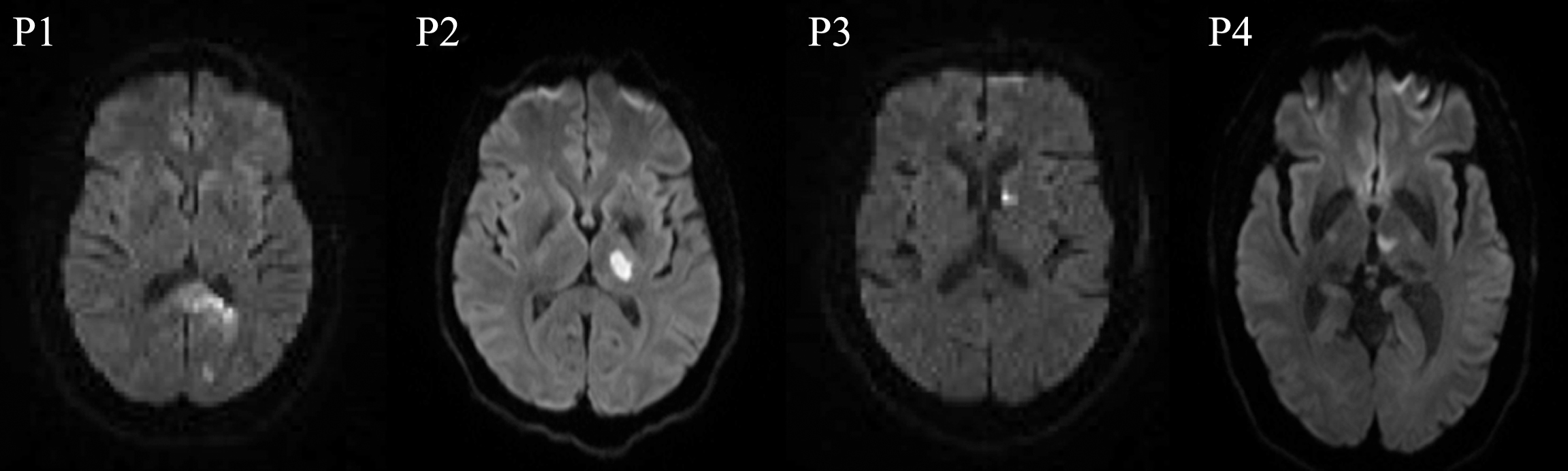 DWI scans at the acute time point for P1with a lesion in the left occipital, fusiform, lingual gyrus, and splenium; P2, P3, and P4 with lesions in the left thalamus.