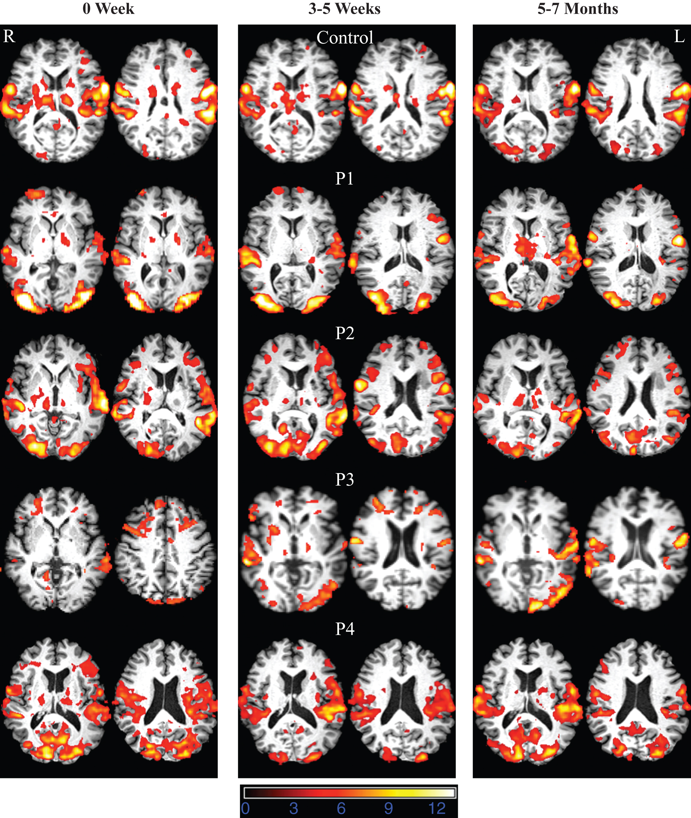 FMRI data registered in MNI space shows areas of activation associated with correct picture naming (phonemic+word cued naming) compared to viewing scrambled pictures at 0W (acute time point), 3–5W (sub acute time point), and 5–7M (chronic time point) for the normal control and participants with aphasia. Z (Gaussianised T/F) statistic images were thresholded using clusters determined by Z > 3.0 and a (corrected) cluster significance threshold of P = 0.05. All images are shown in radiological convention (left in image is right in the brain).