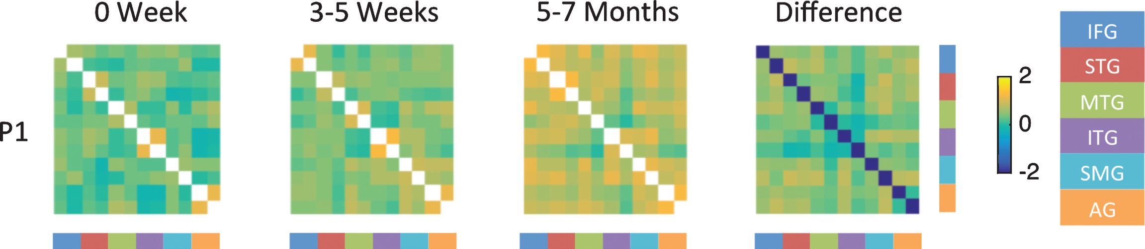 Fisher-transformed correlation matrix for the resting state data for P1 (who showed the most improvement) at each time point. Difference map shows the difference in correlation between the 5–7 month scan and the 0 week scan for the resting state data. Correlations were assessed across 12 ROIs in the language network corresponding to the left and right inferior frontal gyrus (IFG), superior temporal gyrus (STG), middle temporal gyrus (MTG), inferior temporal gyrus (ITG), supramarginal gyrus (SMG), and angular gyrus (AG).