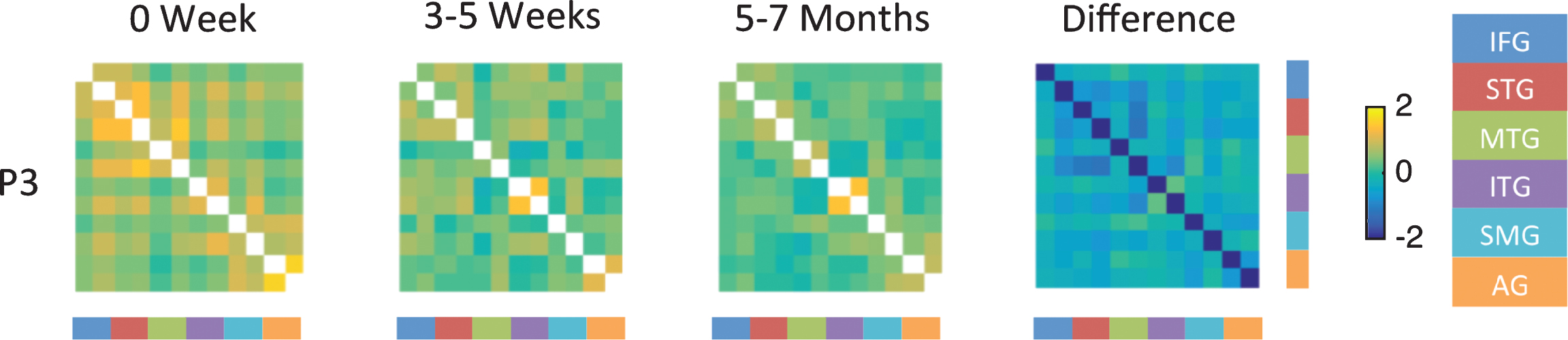 Fisher-transformed correlation matrix for the resting state data for P3 (who showed persistent moderate naming deficit) at each time point. Difference map shows the difference in correlation between the 5–7 month scan and the 0 week scan for the resting-state data. Correlations were assessed across 12 ROIs in the language network corresponding to the left and right inferior frontal gyrus (IFG), superior temporal gyrus (STG), middle temporal gyrus (MTG), inferior temporal gyrus (ITG), supramarginal gyrus (SMG), and angular gyrus (AG).