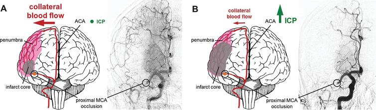 Increase of infarct core volume due to ICP-caused collateral supply decline. (A) Collateral perfusion helps to limit the extent of the ischemic core after stroke if ICP remains low to moderate. (B) Steeply increasing ICP can dramatically reduce collateral blood flow after ischemic stroke, since the cerebral perfusion pressure equals to the mean arterial pressure minus ICP as suggested by the Monro–Kellie doctrine. Challenging conventional knowledge suggesting that edema is the major cause of ICP increase, Murtha and colleagues could show that even minor ischemic lesions causing mild edema might lead to significant ICP rises. This may represent an important pathophysiological mechanism contributing to significant cerebral damage even after initial minor strokes with larger penumbras with good collateralization. A potential therapeutic strategy might be the application of mild hypothermia, which has been demonstrated to prevent the ICP rise after even minor strokes. Angiograms were taken from Shuaib et al., 2011.