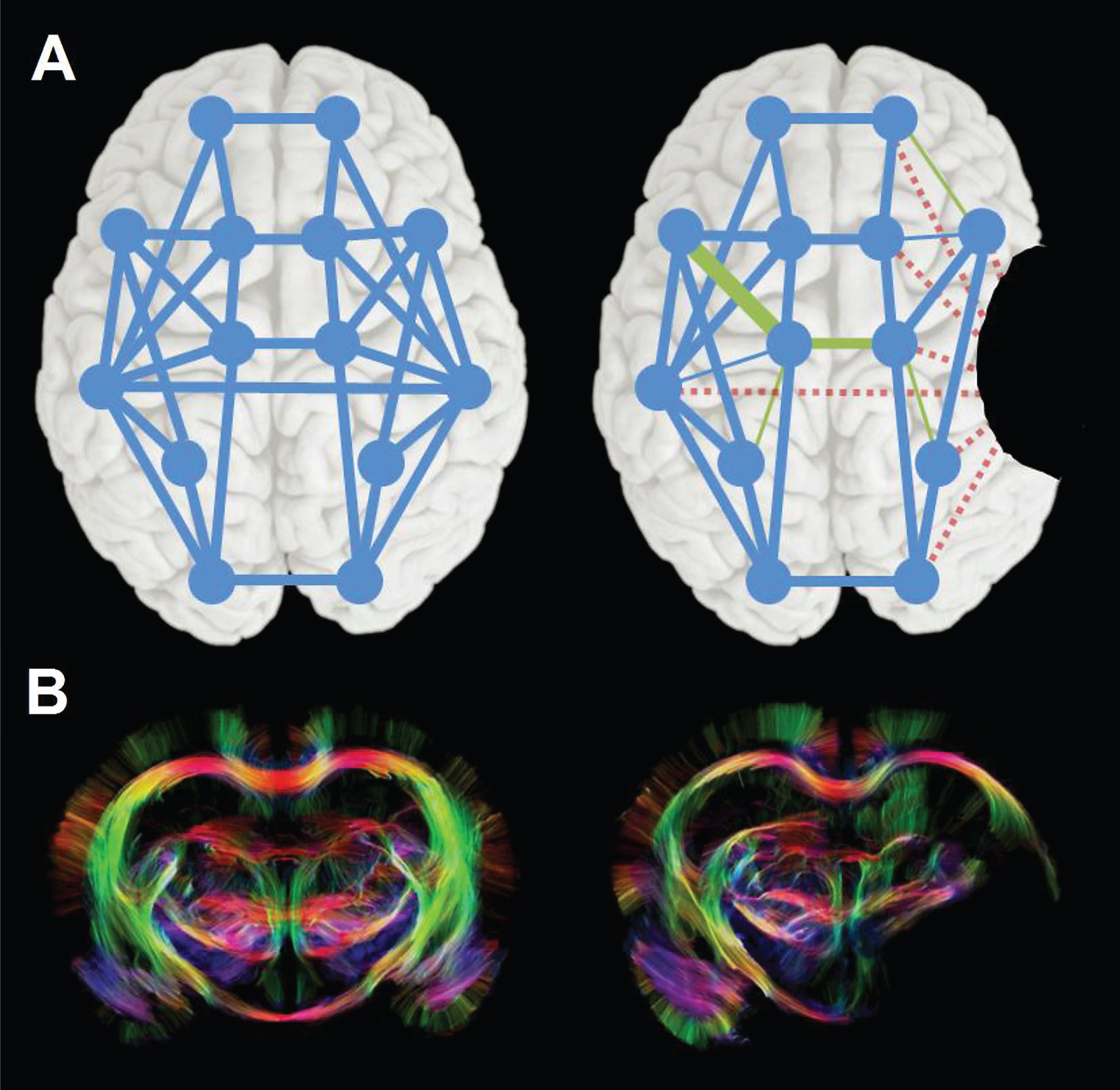 Changes in neural network connectivity after stroke. (A) Schematic representation of a neural network in human brain before (left), with nodes and edges in blue, and after stroke (right), illustrating global disconnection (red dotted edges) and reorganization (green edges) as a result of a focal stroke lesion (black area). (B) Diffusion tensor imaging-based fiber tractography maps of control (left) and 10-weeks post-stroke rat brain (right), showing altered fiber pathway patterns in perilesional white matter chronically after stroke. Stroke was induced by 90-min intraluminal occlusion of the right middle cerebral artery in adult male Sprague Dawley rats. High angular (120 directions) and spatial resolution (0.2 mm isotropic voxels) diffusion-weighted MRI data were acquired post mortem on a 9.4 T animal MRI scanner (total scan time: 26 h). MrTrix3® software (http://www.mrtrix.org/) was used for diffusion-based tractography. Courtesy of Michel Sinke and Willem Otte.