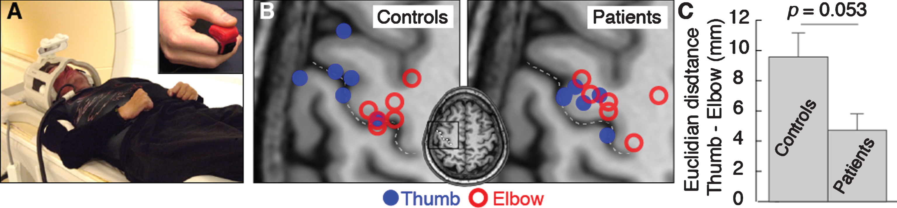 (A) Experimental setup. (B) Activation center of gravity for thumb (blue) and elbow (red) flexion activations in control participants and patients. The central sulcus is indicated by the dotted line. (C) Mean cortical distance between thumb and elbow flexion activation centers of gravity for control participants and patients. Error bars indicate standard error of the mean. Significance of the planned comparison (one-tailed t-test) is shown.