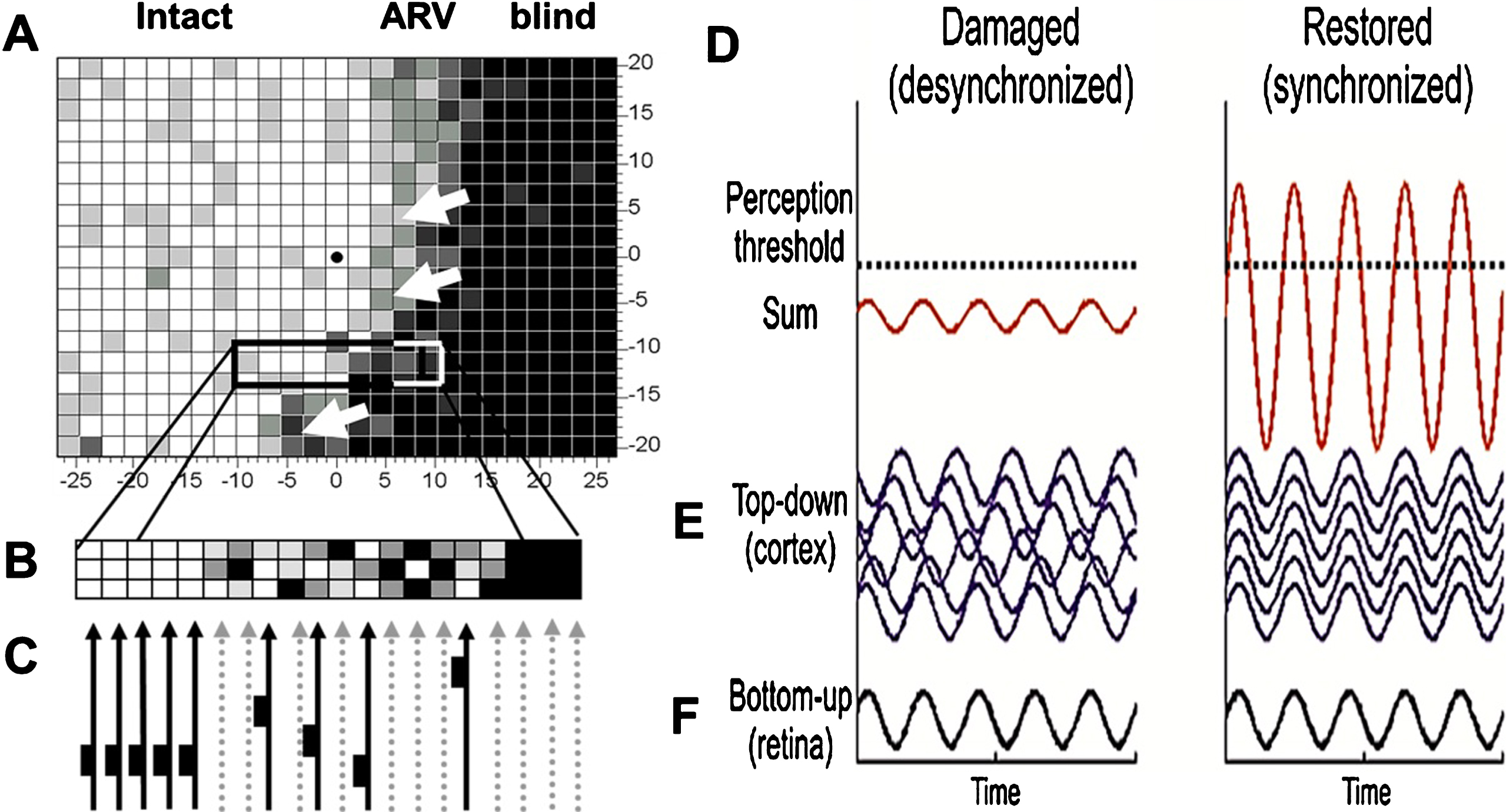 Residual vision and brain network amplification. (A) This graph serves only as a conceptual guide to appreciate the nature of residual vision and the interactions of retina and brain by neuronal oscillatory activity. Accordingly, vision loss (e.g. measured by detection ability) depends on how many cells are lost: the greater the cell loss, the greater is the defect in different regions of the visual field. Areas of residual vision (ARVs; shown in grey) correspond to regions of partial damage with or without vascular dysregulation. They are found in all kinds of visual field defects such as after stroke (e.g. hemianopia) or retinal or optic nerve damage (e.g. glaucoma). Black areas represent complete damage. Note, however, that many black regions may, in fact, have some residual visual function as well. (B) Whether or not visual stimuli processes by the retina are consciously perceived by the brains is not only determined by the strength of the neuronal signals sent by the retina to the brain, but it also depends on how the brain processes this information through synchronization, amplification and interpretation. Neural activity of the retina is represented here by a simple sine wave. If the brain network is disorganized (illustrated here by non-synchronized, out-of-phase brain sine waves), the sum of retinal and brain signals is too low to surpass the perceptual threshold and the visual stimulus is not perceived. When the brain is synchronized, this elevates (amplifies) the same residual visual signal to above-threshold perception, thus improving or restoring conscious vision.