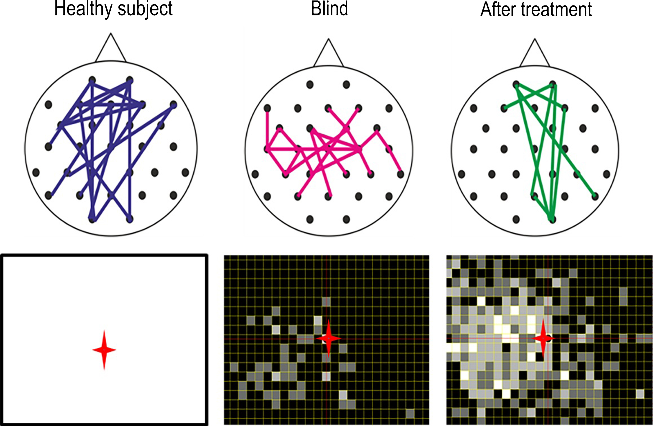 Brain functional network reorganization. Healthy subjects have a strong functional connectivity network between occipital and frontal regions of the brain. But in patients with visual field defects this network is lost. When treated for 10 days with alternating current stimulation, this network is partially restored (Bola et al., 2014). Lower panel: As the brain functional connectivity recovers, so does the visual field (shown here with supra-threshold campimetry) (Sabel, 2016).