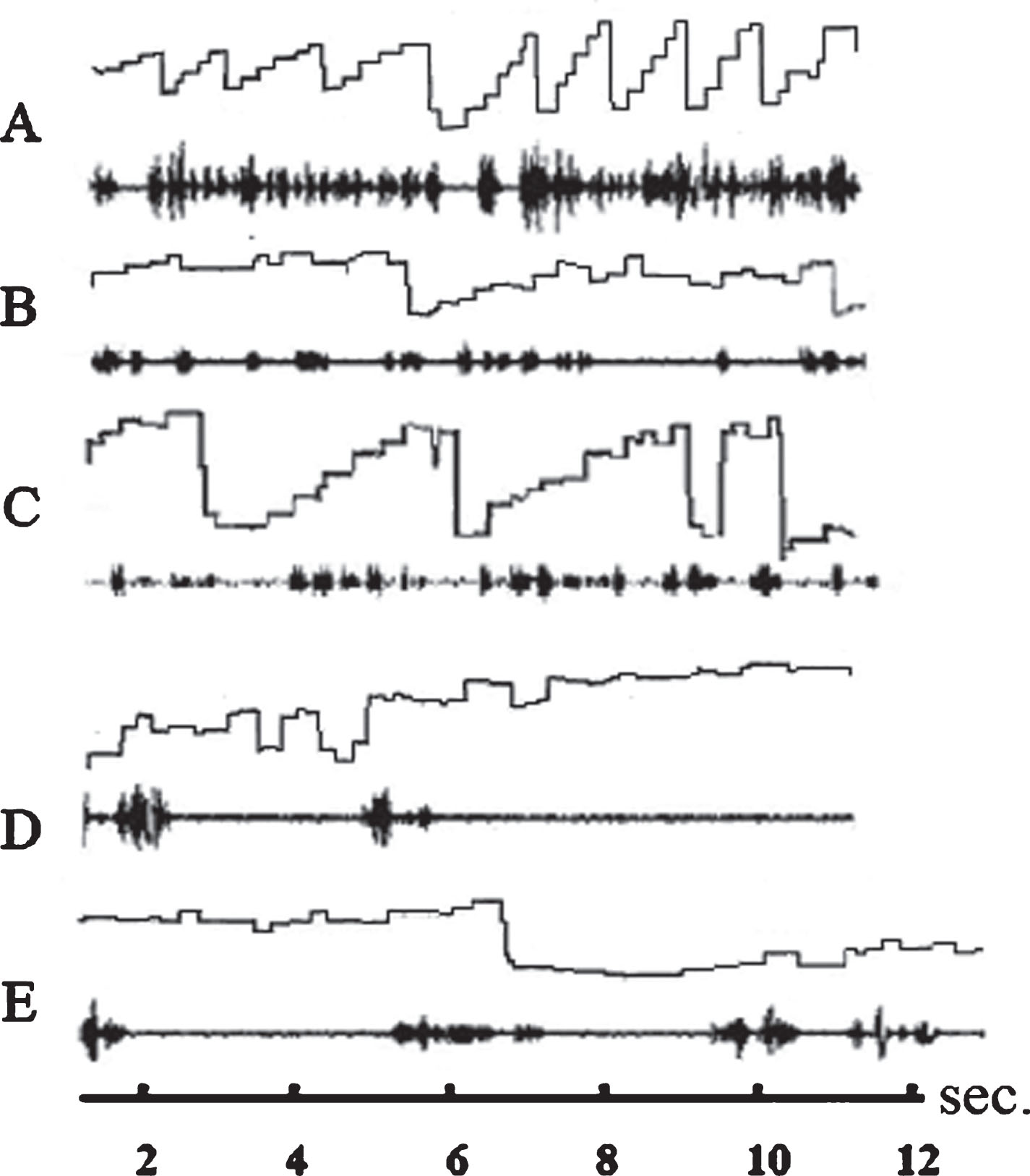 Eye movements and speech recording of three subjects while reading a text from the ZLT. Abscissa: time axis; ordinate: amplitude of eye movements. Ascending line: eye movement to the right; descending line: eye movement to the left. The spectrogram of the reader’s language is displayed below each graphic representation of eye movements. A: ideal staircase eye movements of a good reader (not included in the study). B: eye movements and speech spectrogram of a dyslexic reader before therapy. The subject is reading slowly with only few staircase-like eye movements and many eye movements against the reading direction (reversions). C: eye movements and speech spectrogram of the same subject after therapy. Sequences during which the subject performs staircase-like eye movements are more frequent than before therapy but there are still many reversions. D: eye movements and speech spectrogram of a dyslexic subject who is reading very slowly. The subject speaks only after having performed a series of searching eye movements. E: The subject performs more staircase-like eye movements but executes still many reversions. The speech is much more fluent. All subjects reduce reading mistakes after therapy by almost two thirds.