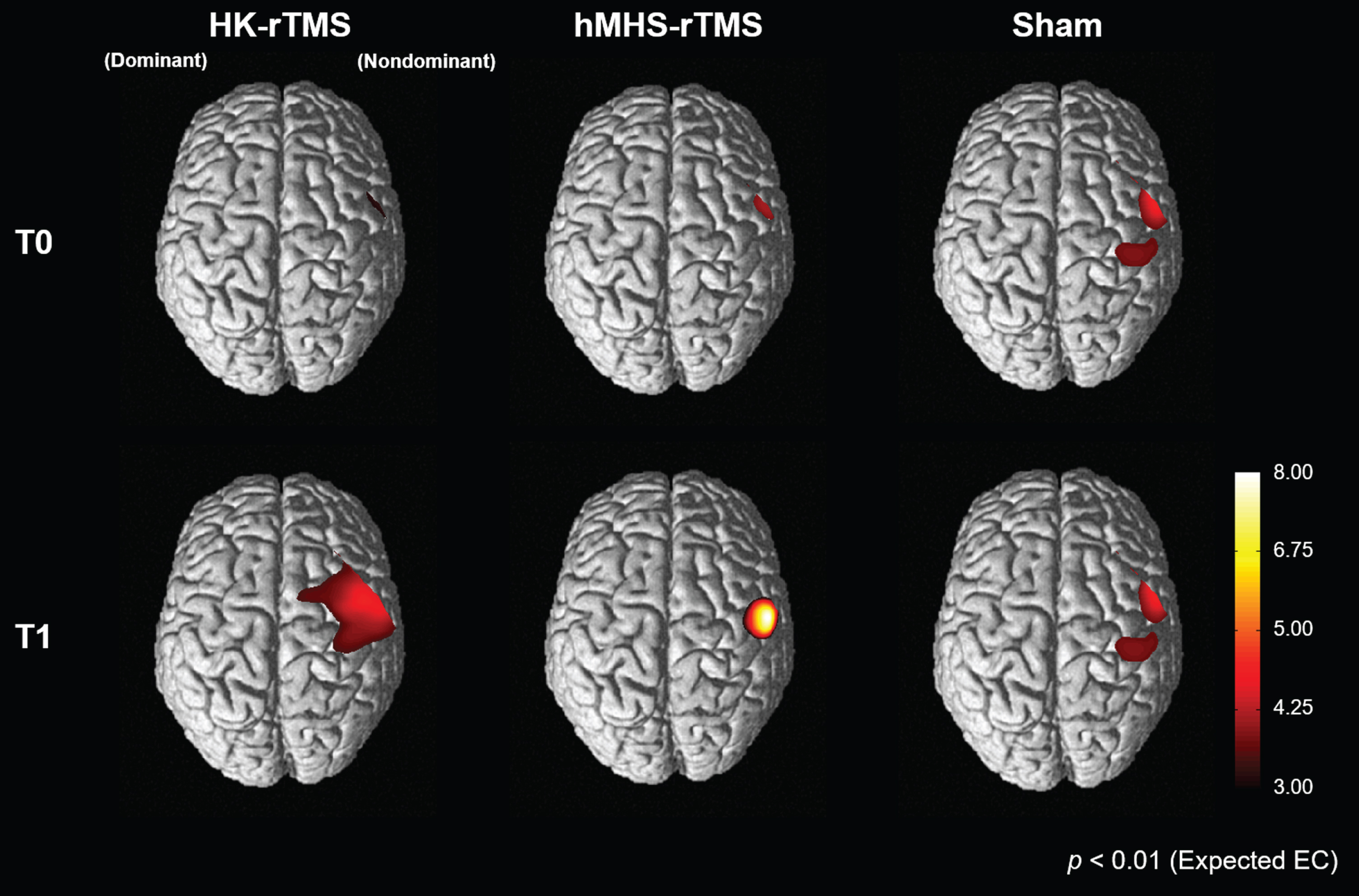 Cortical activation patterns during a non-dominant serial reaction time task before (T0) and after (T1) rTMS stimulation. Cortical activation of the non-dominant hemisphere increased after low-frequency rTMS in the HK-rTMS and hMHS-rTMS. There was no significant change in the Sham-rTMS. T0, before rTMS stimulation; T1, after rTMS stimulation; rTMS, repetitive transcranial magnetic stimulation; HK, anatomical hand knob; hMHS, hand motor hotspot