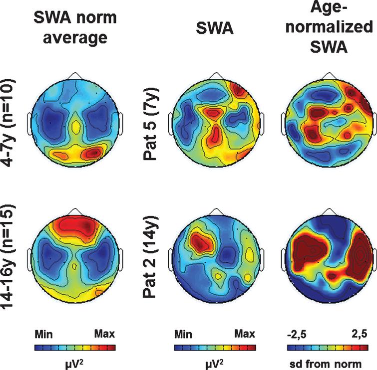 Examples of SWA age norm, individual SWA and age-normalized SWA (at T1). (Left column) SWA average topographies for two age groups. (Middle column) Individual SWA topographies for two patients. (Right column) Age-normalized individual SWA topographies (sd from norm). Maximal values are indicated in red, minimal values in blue.