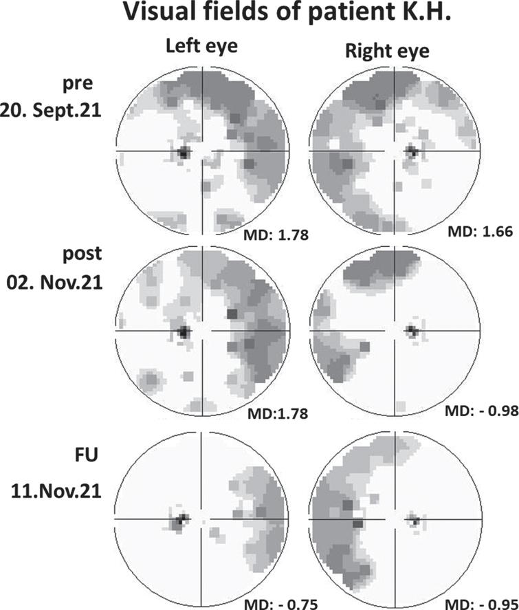 Recovery of 75-degree Oculus visual field of each eye in patient K.H. following NIBS treatment. Dark areas represent regions of vision loss. They are located in nasal visual field in both eyes and improve following treatment, with additional recovery at follow-up. (MD = mean deviation. Note that positive values indicate the patient is worse than her age norm; negative values indicate that the patient is better then her age group).