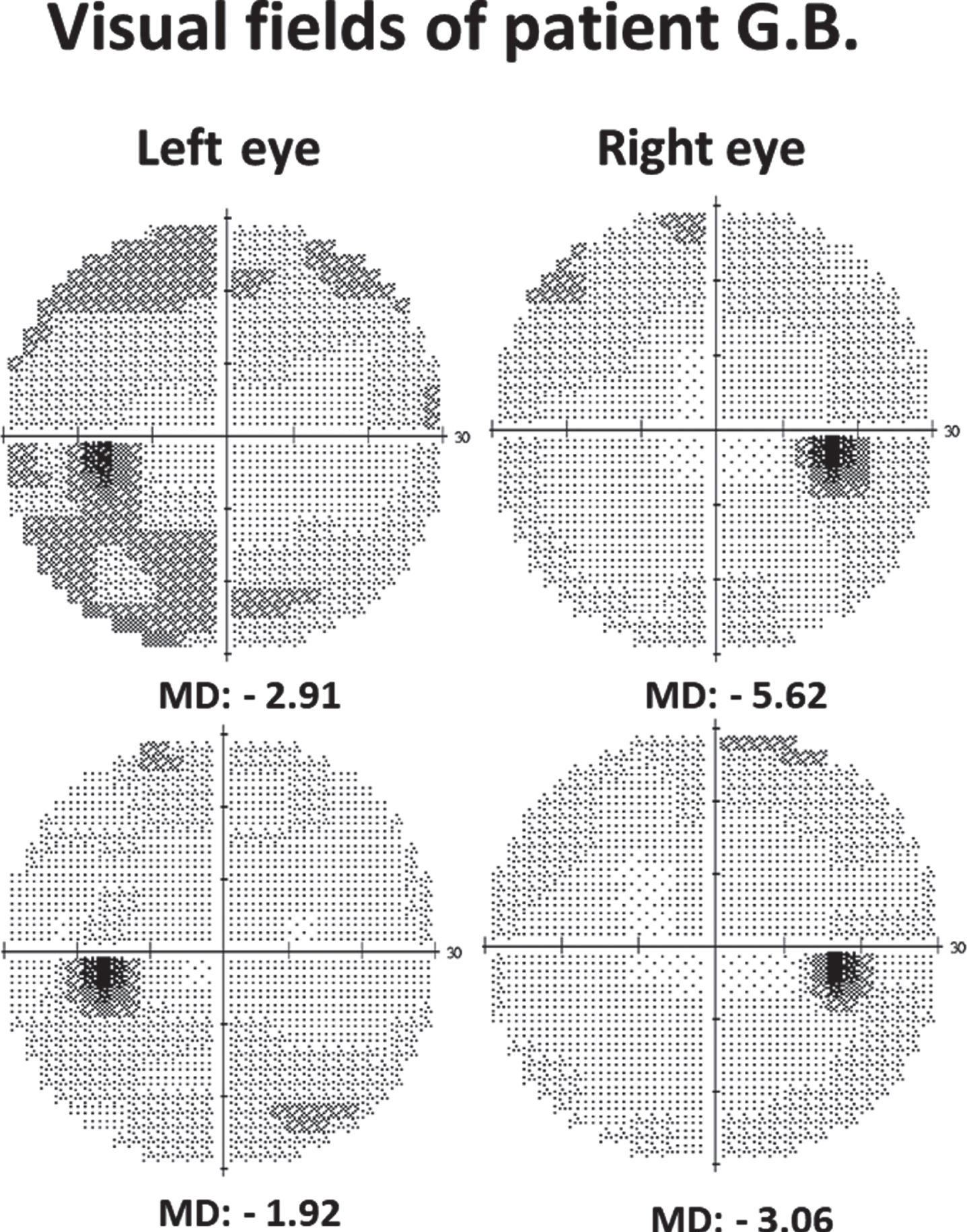 Recovery of 30-degree Humphrey visual field in patient G.B. following NIBS treatment (MD = mean deviation: lower negative values (i.e., closer to zero) indicate more vision in this perimetry).