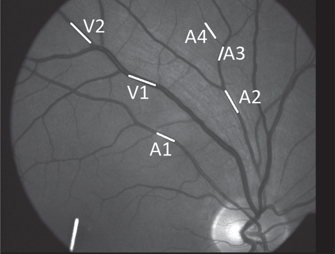 Example of a retinal image in Patient K.H. The DVA analysis program quantifies the absolute vessel diameter in MU (measurement unit) using the Gullstrand’s eye as a template. The average of three 30s recording just prior to every flicker light was taken as the baseline value (100%) for the analysis of the evoked dilation response. Larger and smaller arteries and veins at different branch orders: first (A1, V1), second (A2, V2), third (A3) and fourth order (A4). Because the DVA images focus mostly on the central retina, only few 3rd or 4th order vein branches can be measured.