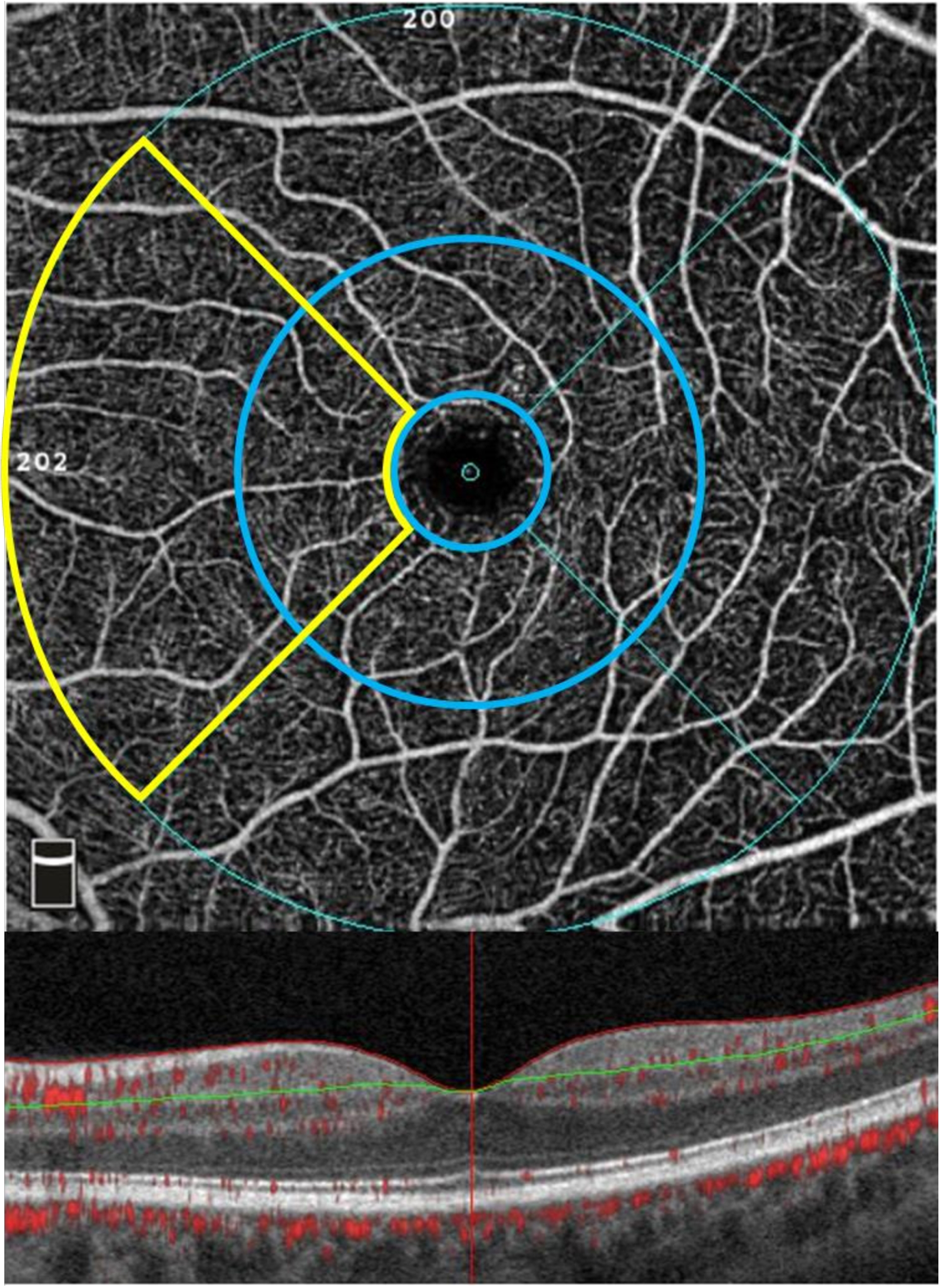 OCT angiography of the macular regions affected in hereditary spastic paraplegia. Superficial parafoveal (inner circular area outside of foveal avascular zone highlighted in blue, upper en face image) and perifoveal (outer circular area, upper en face image) capillary network extending from the internal limiting membrane (red line, lower B-scan image) to the outer boundary of the inner plexiform layer (green line, lower B-scan image). Nasal region (combined parafoveal and perifoveal average) of the nasal superficial vascular plexus (nSVP) highlighted in yellow.