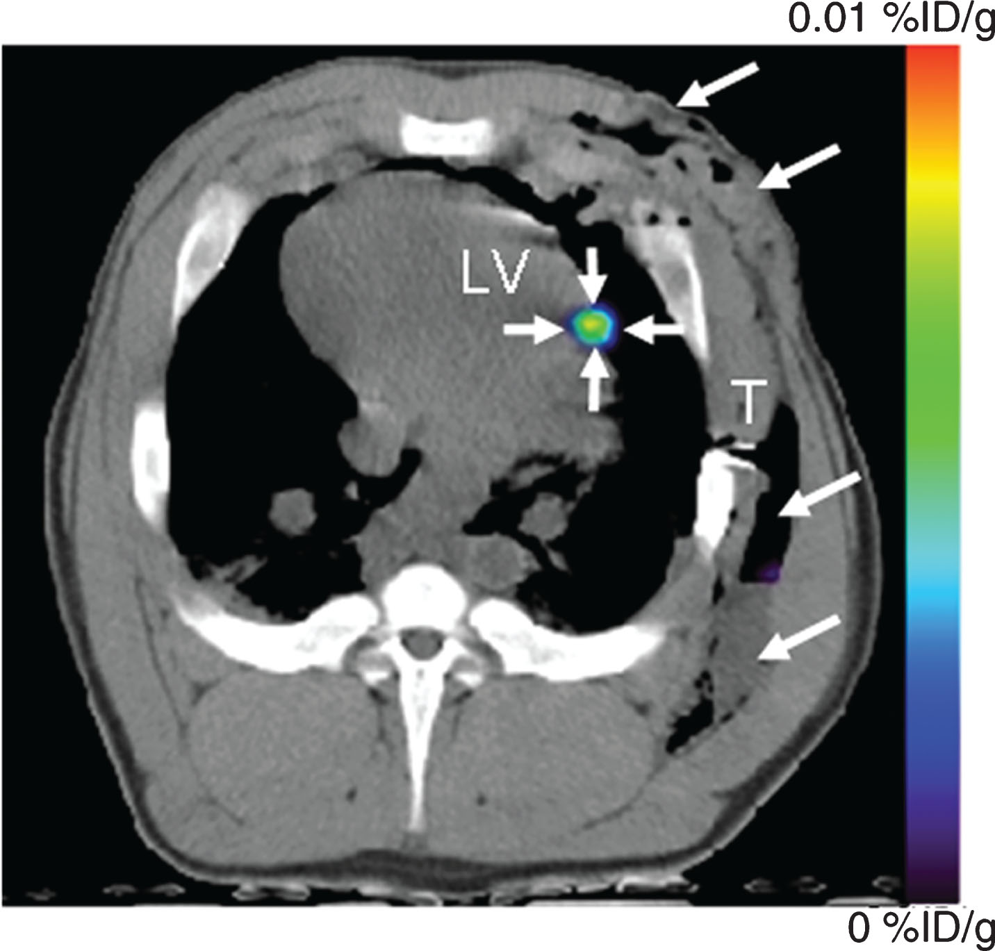 PET-CT imaging of intramyocardial reporter gene expression in swine. (a) Transverse nonenhanced PET-CT fusion image reconstructed at the level of the left ventricle (LV) after direct open-chest administration of transduced human MSCs. The image was acquired 4 hours after intravenous FHBG administration. A distinct imaging signal (small arrows) can be delineated at the intramyocardial injection site of human MSCs. Note postoperative soft-tissue edema, emphysema, and fluid collection in the left chest wall (large arrows). T = beveled part of chest tube. Reprinted from Willmann J, et al. Imaging Gene Expression in Human Mesenchymal Stem Cells: From Small to Large Animals. Radiology 2009 Jul;252(1):117-27 with permission.