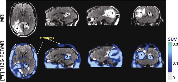 Human stem cell imaging. MRI and PET over MRI superimposed brain images of the patient who had been infused autologous cytolytic T cells expressing IL13 zetakine and HSV1-tk genes. Images were acquired approximately two hours after 18F-FHBG injection. The patient had a surgically resected tumor (1) in the left corner and a new non-resected tumor in the center (2), near corpus callosum of his brain. The infused cells had localized at the site of tumor 1 and also trafficked to tumor 2. 18F-FHBG activity is higher than the brain background at both sites. Background 18F-FHBG activity is low within the Central Nervous System due to its inability to cross the blood brain barrier. Background activity is relatively higher in all other tissues. Activity can also be observed in the meninges. The tumor 1/meninges and tumor 2/meninges 18F-FHBG activity ratio in this patient was 1.75 and 1.57, respectively. Whereas the average resected tumor site/meninges and intact tumor site to meninges 18F-FHBG activity ratio in control patients was 0.86 and 0.44, respectively. Reprinted from Yaghoubi S, et al. Noninvasive Detection of Therapeutic Cytolytic T Cells with 18F-FHBG PET in a Patient with Glioma. Nat Clin Pract Oncol 2009 Jan;6(1):53-8 with permission.