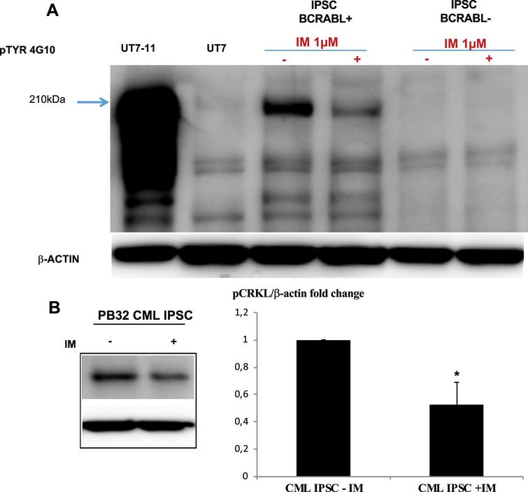 Evaluation of BCR-ABL phosphorylation in CML iPSC line PB32. (A) Evaluation of BCR-ABL phosphorylation levels by Western blot analysis using a phospho-tyrosine antibody (4G10 clone). Lane 1 and 2: BCR-ABL-positive cell line UT7-11 and its negative counterpart control UT7; Lane 3 and 4: PB32 CML iPSC with and without Imatinib; Lane 5 and 6: A control iPSC line without Ph1 chromosome, cultured with and without Imatinib. (B) ImageJ quantification of pCRKL protein in CML IPS cell line with and without Imatinib.