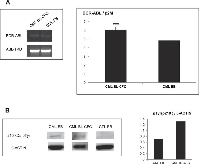 BCR-ABL expression in embryoid bodies (EBs) and Bl-CFC cells derived from CML iPSC. 5A (Left panel): PCR analysis to detect BCR-ABL in CML iPSC-derived blast colony forming cells (Bl-CFC) and embryoid bodies (EB). 5A (Right panel): Expression profile of BCR-ABL gene by RT-qPCR in CML iPSC-derived Bl-CFC and EB. 5B (Left panel): Western blot analysis to detect BCR-ABL phosphorylation level using a phospho-tyrosine antibody. 5B (Right panel): ImageJ quantification of pTYR in iPSC-derived EB and Bl-CFC.