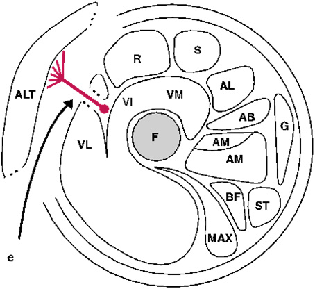 Operative approach to the vascular pedicle of ALT flap (e) F: femur, A: acetabulum, T: tensor fascia latae, MAX: gluteus maximus, MED: gluteus medius, R: rectus femoris, S: sartorius, IP: iliopsoas, OI: obturatorius internus, VL: vastus lateralis, VI: vastus intermedius, VM: vastus medialis, AL: adductor longus, AB: adductor brevis, AM: adductor medius, Am: adductor minimus, G: gracilis, ST: semitendineus, BF: biceps femoris, ALT: anterior lateral thigh.